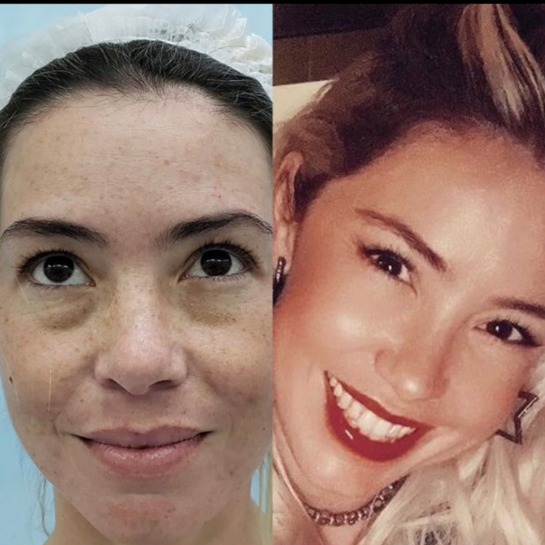 Blepharoplasty, Pic 1.png