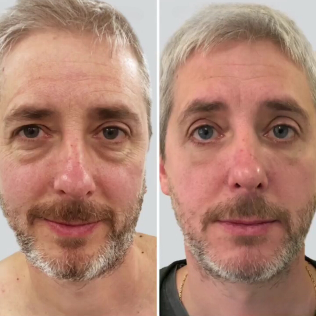 Blepharoplasty, Pic 8.png