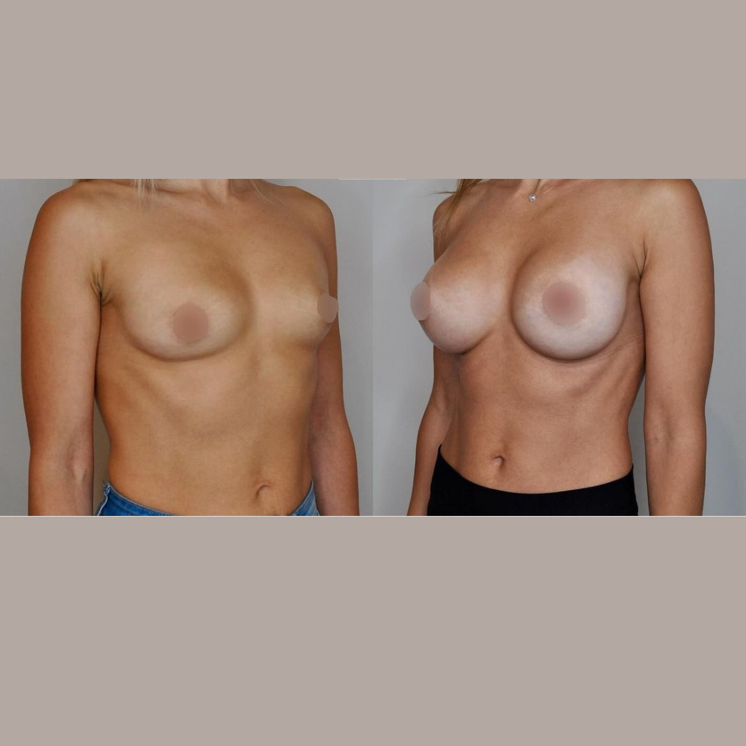 Breast Augmentation, Pic 6.png