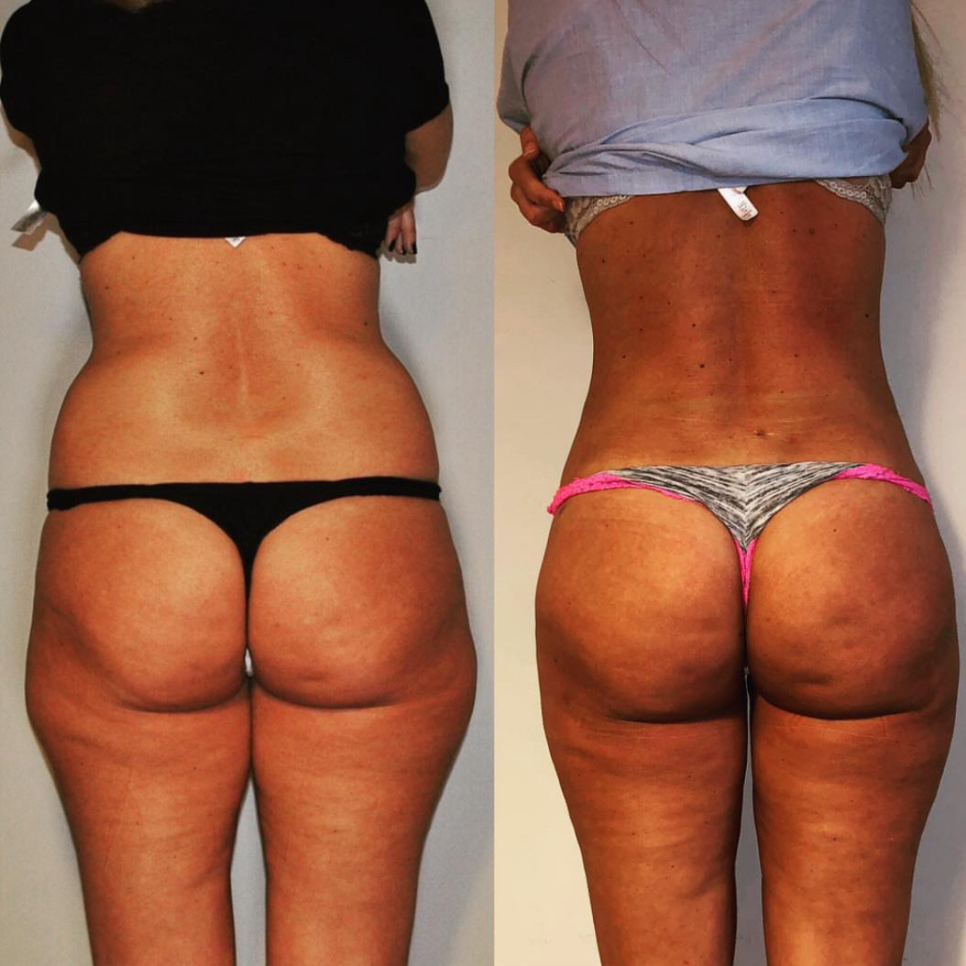 Liposuction, Pic 1.png