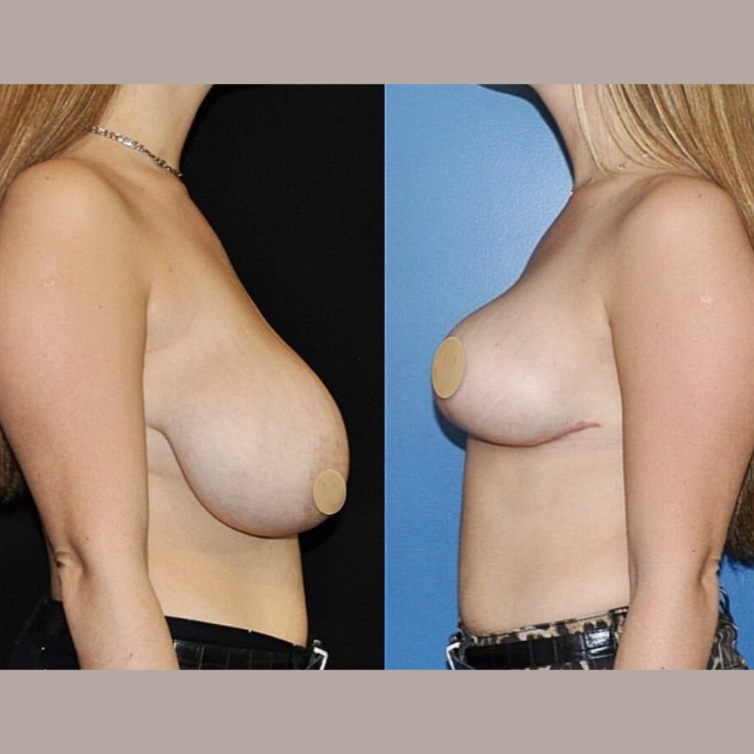 Breast Reduction, Pic 4.png