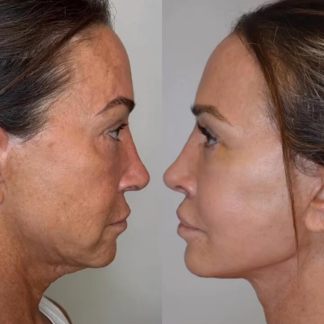 Face Lift, Pic 14.png