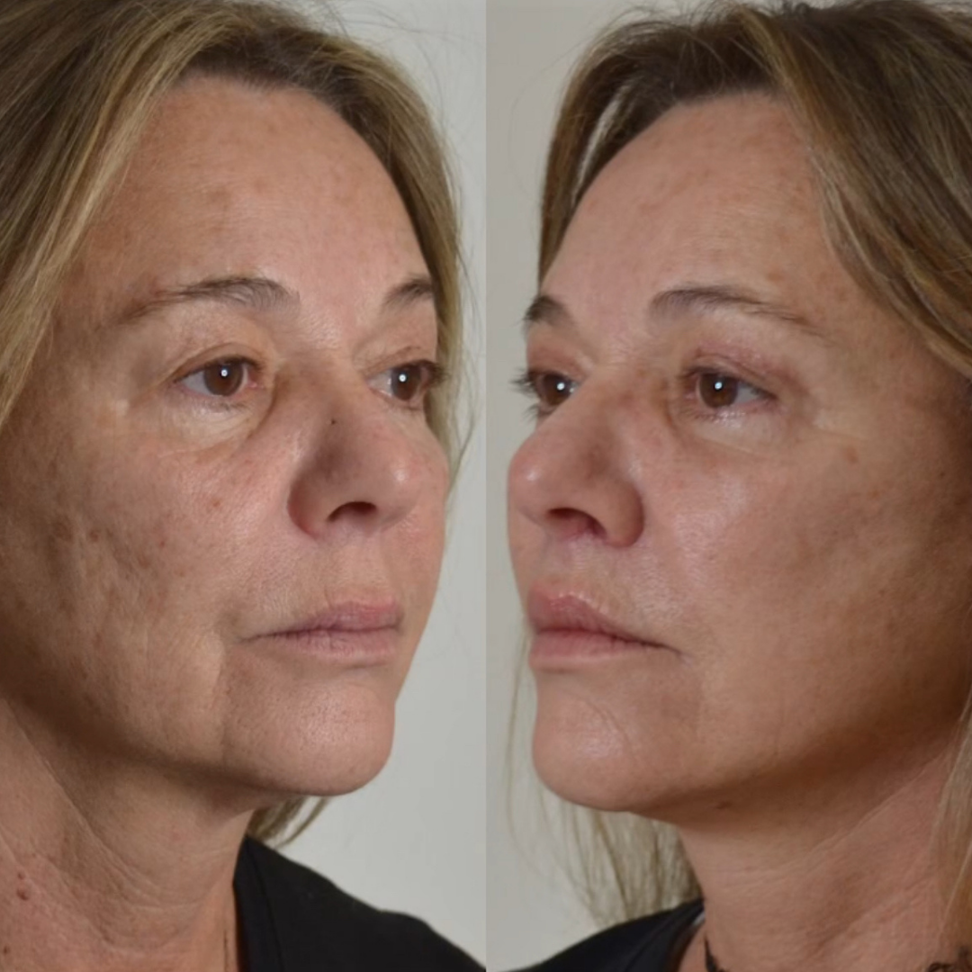 Face Lift, Pic 19.png