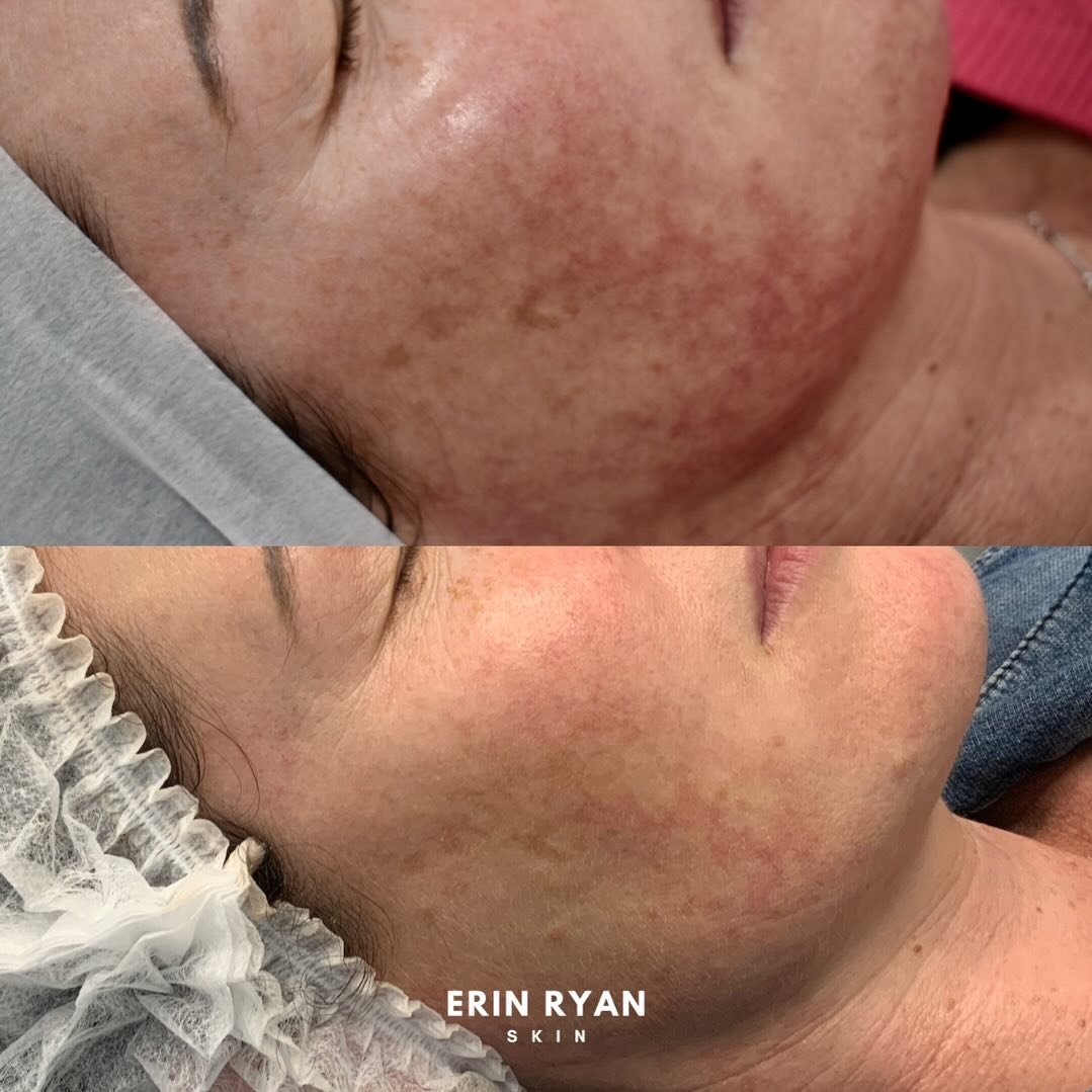 Advanced skincare treatments, tailored for you.

Visible results achieved with 3 corrective laser treatments.

Book a consultation via the link in our bio.

#laserexpert #laserrejuvenation #rosacea #rednessrelief #skincaretips #skincareroutine #derma