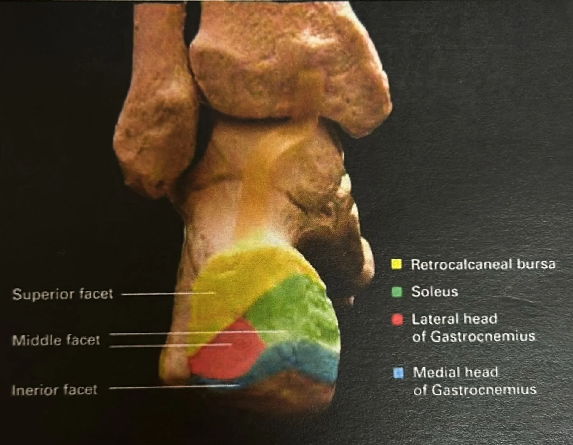 Lámina anatómica que ilustra los relieves óseos del calcáneo, destacando la tuberosidad, sustentáculo tali, cavidad calcánea y superficies articulares, utilizada como recurso educativo en el centro de formación HARA.