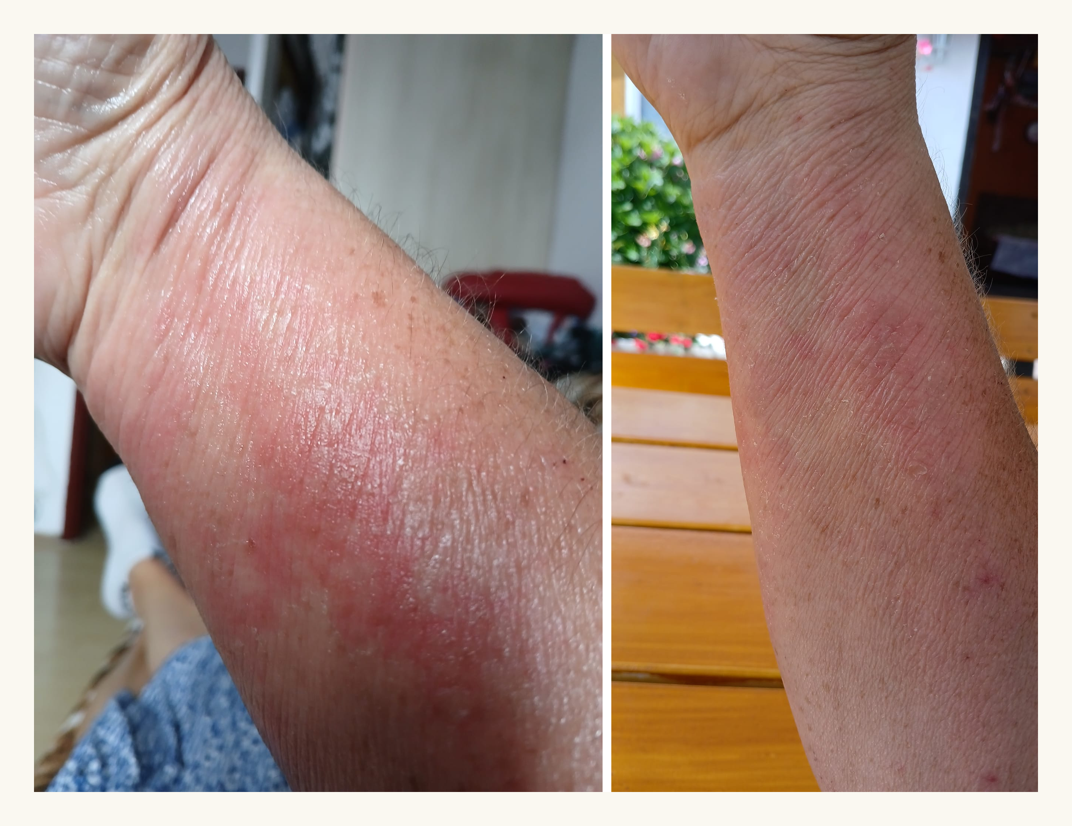 forearm_before_after_pair (1).png
