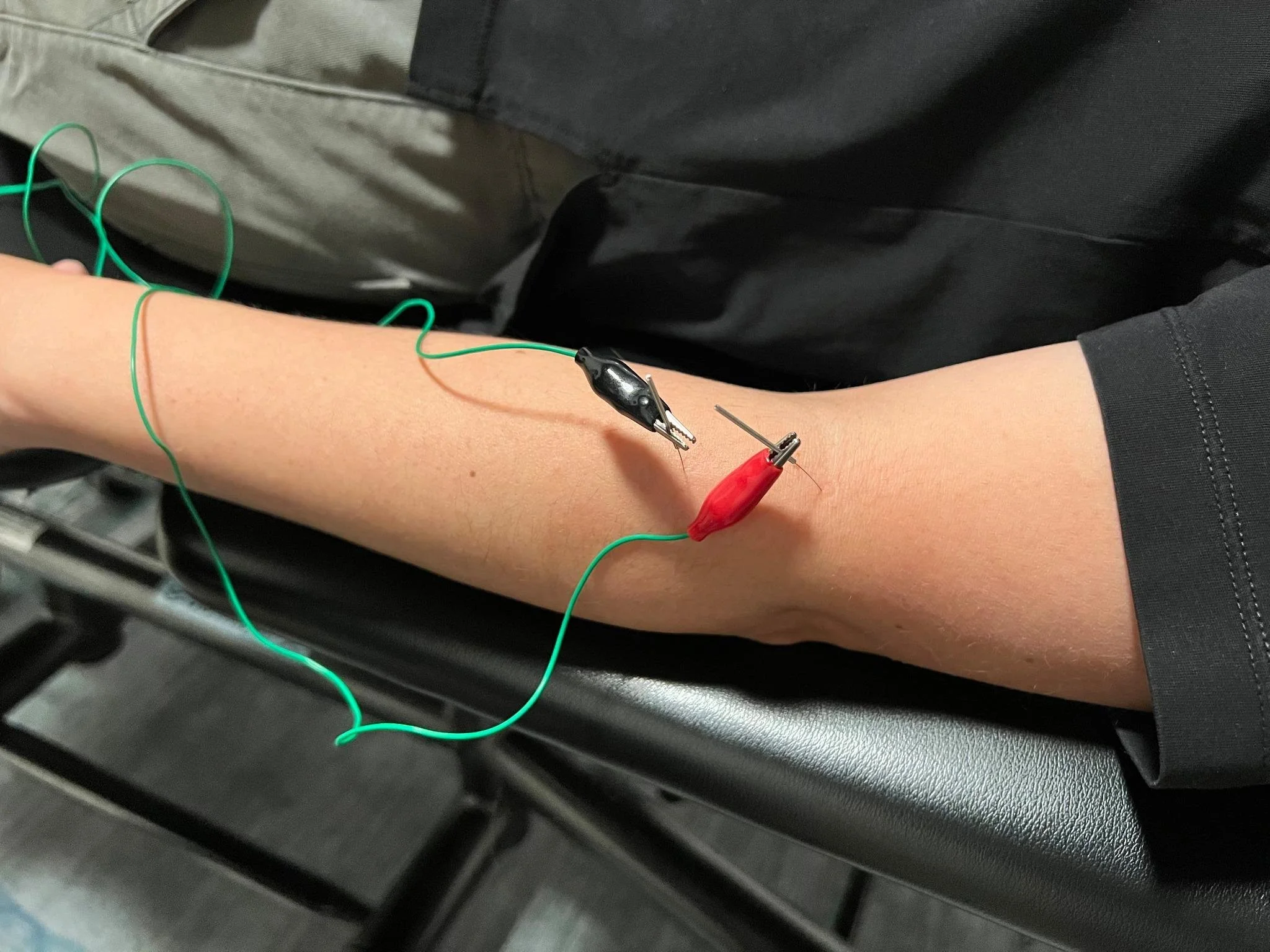 Acupuncture treatment for tennis elbow at 416 Physio