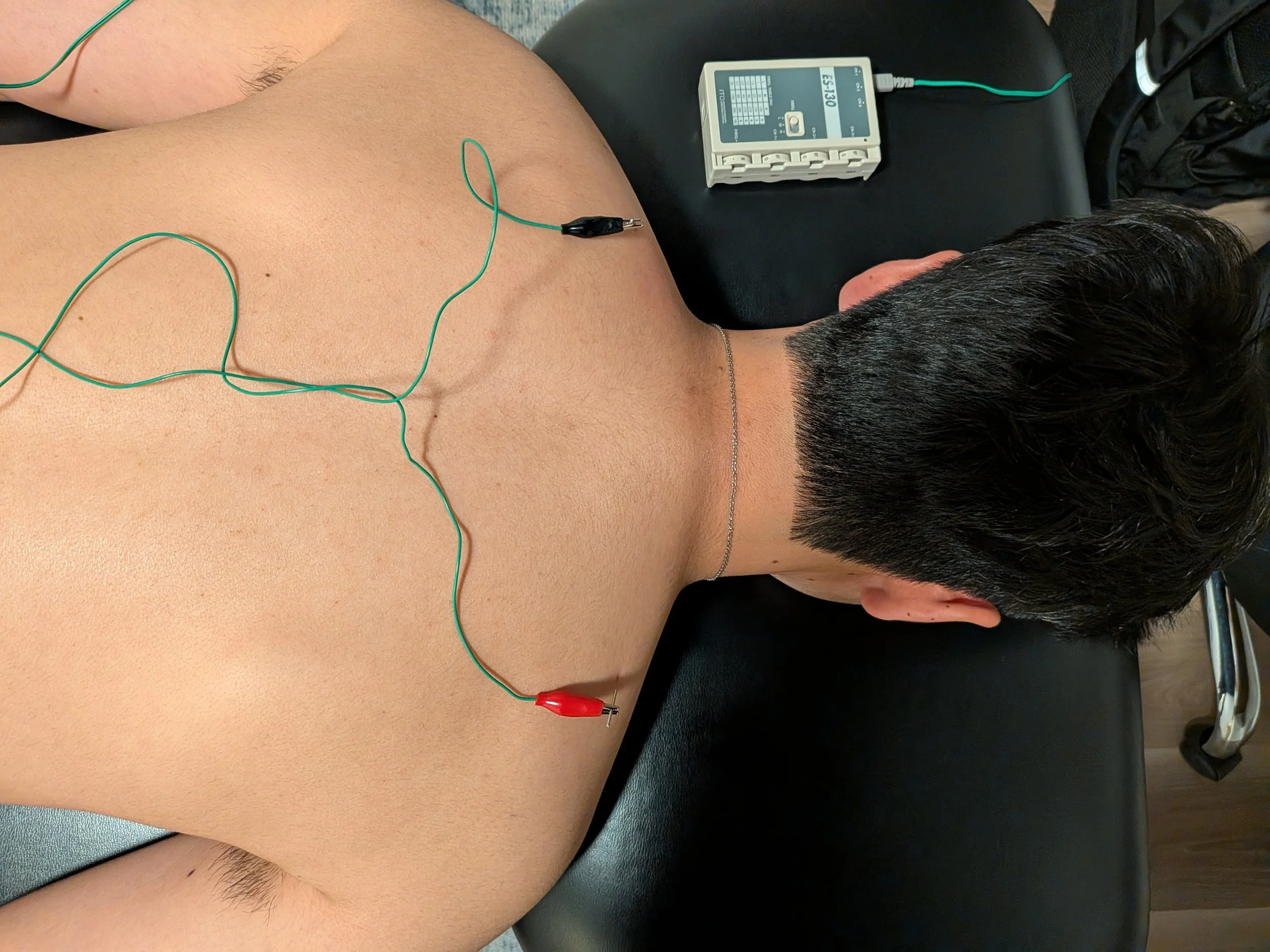 Dr. Sahib Gill providing acupuncture treatment to a patient's neck and upper back