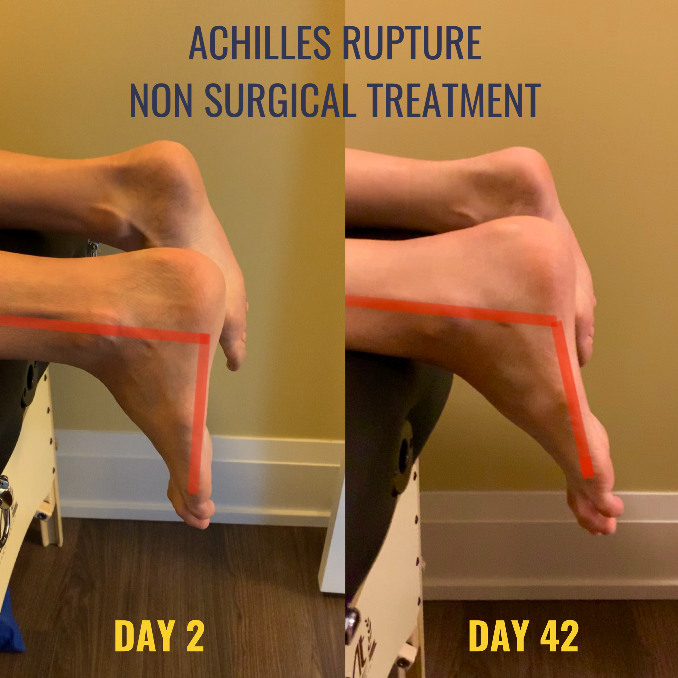 Two images of a ruptured Achilles tendon demonstrating the progression of healing with the tendon held in a shortened position.