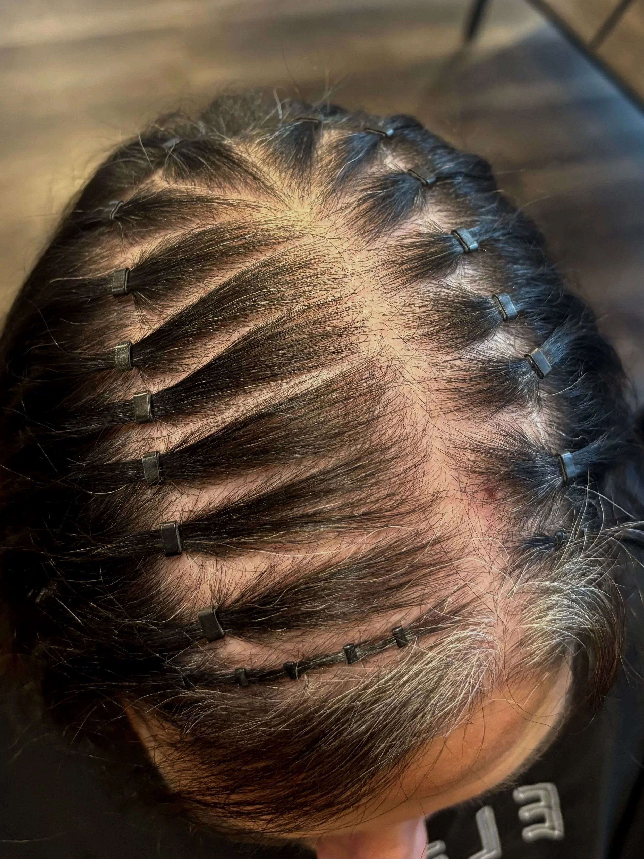 A person with dark hair undergoing a hair treatment, with some hair sections clipped and lifted, revealing scalp and thinning areas.