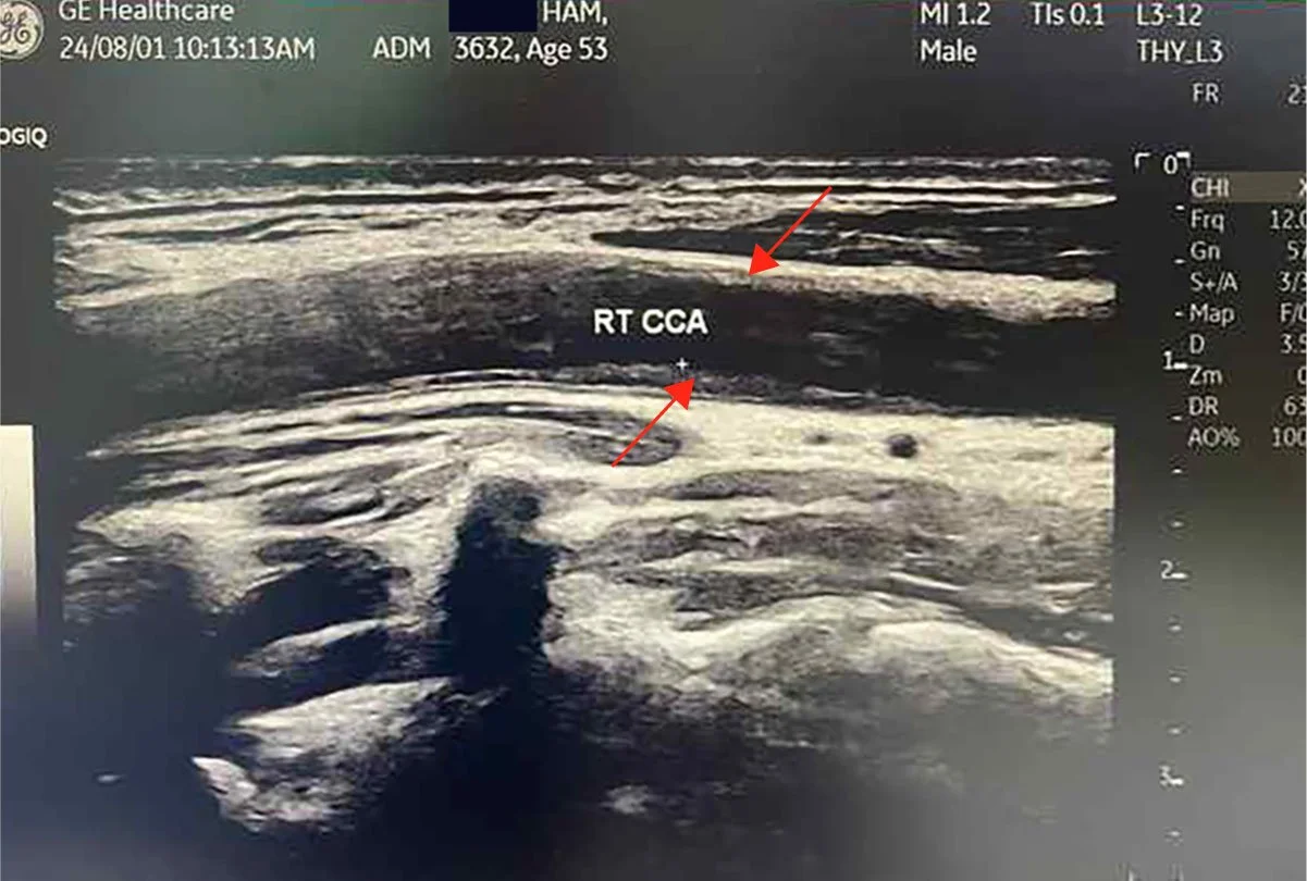 RT CCA · Longitudinal · Baseline