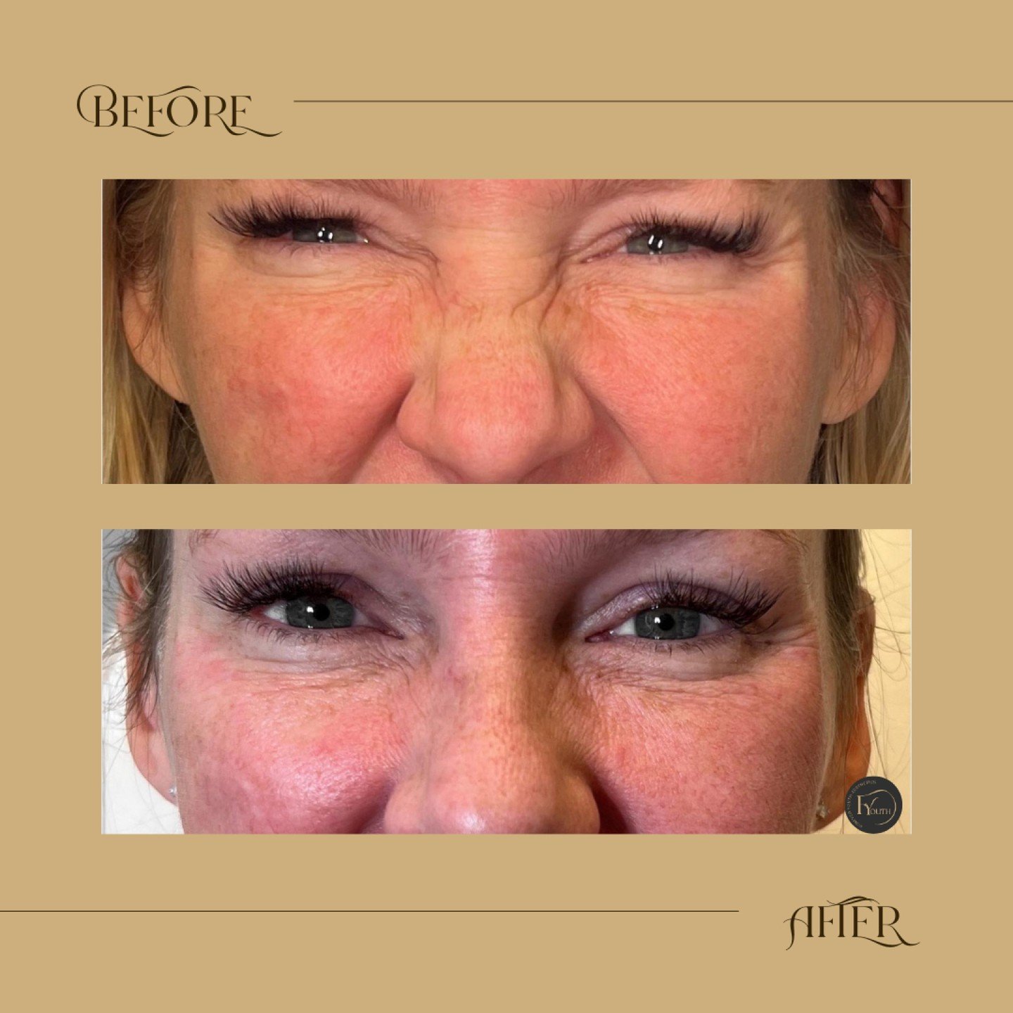 Say goodbye to nose wrinkles and bunny lines! 

These wrinkles, often seen when smiling or laughing, are caused by the repeated contraction of the nasalis muscle.

Our targeted treatment involves a precise application of Neuromodulators (Botox, Dyspo