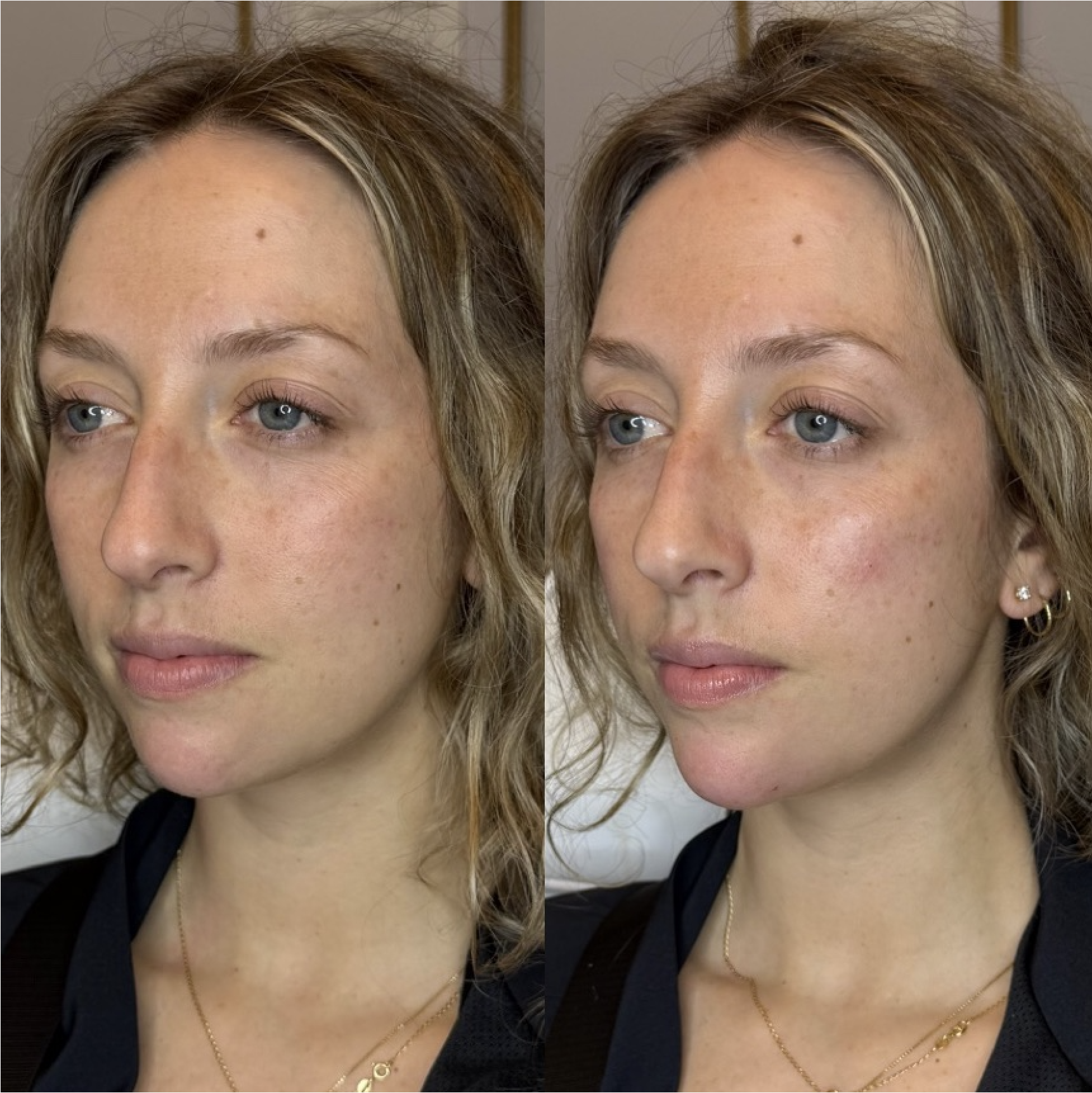 Cheeks and Chin Facial Balancing in Belleville, Ontario