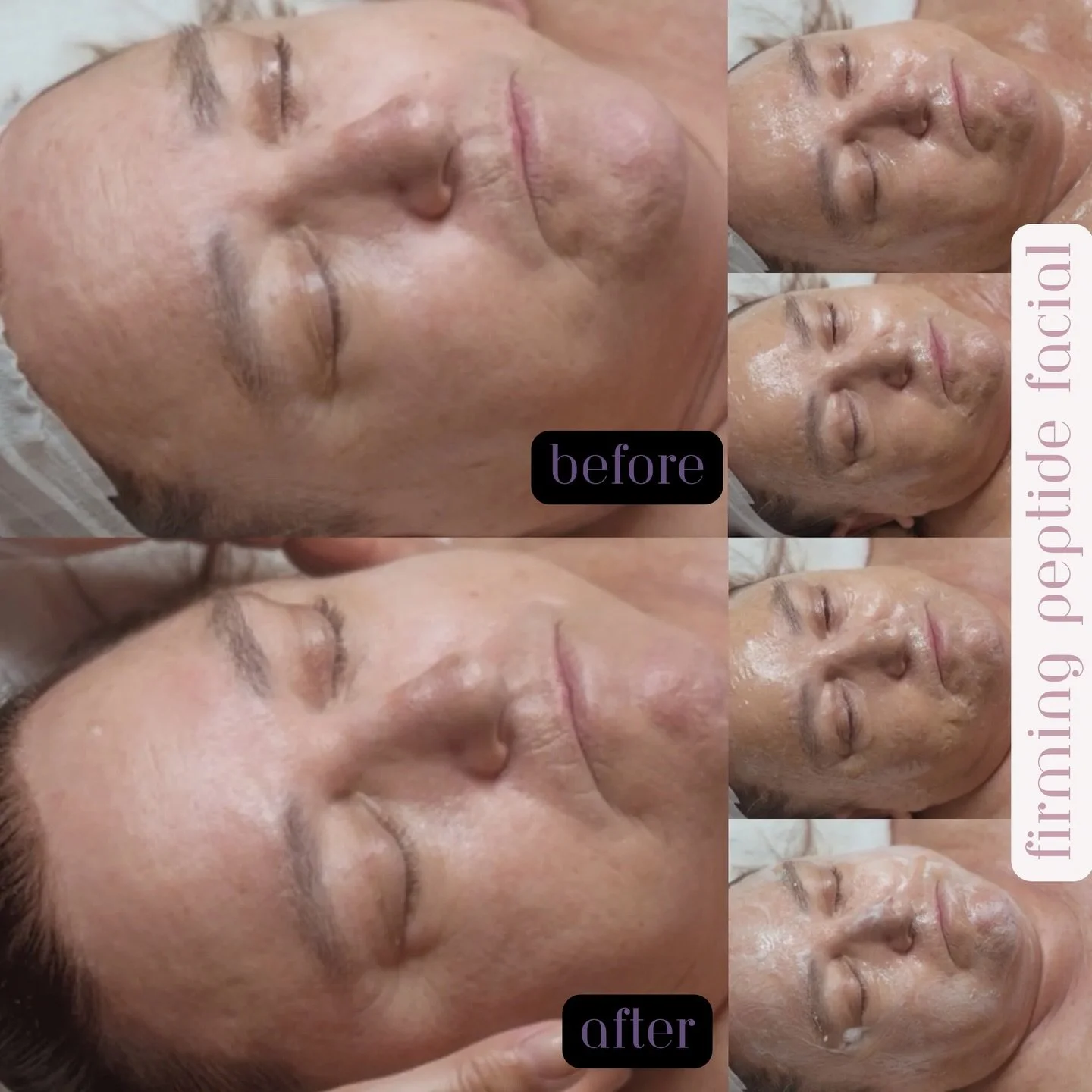 The firming peptide facial in action ✨

Schedule this renewing treatment giving you instant results. With our Lunar New Year Special this service is $77.77 🧧

As this mask sits on your skin, you start to experience a tightening effect that helps pul