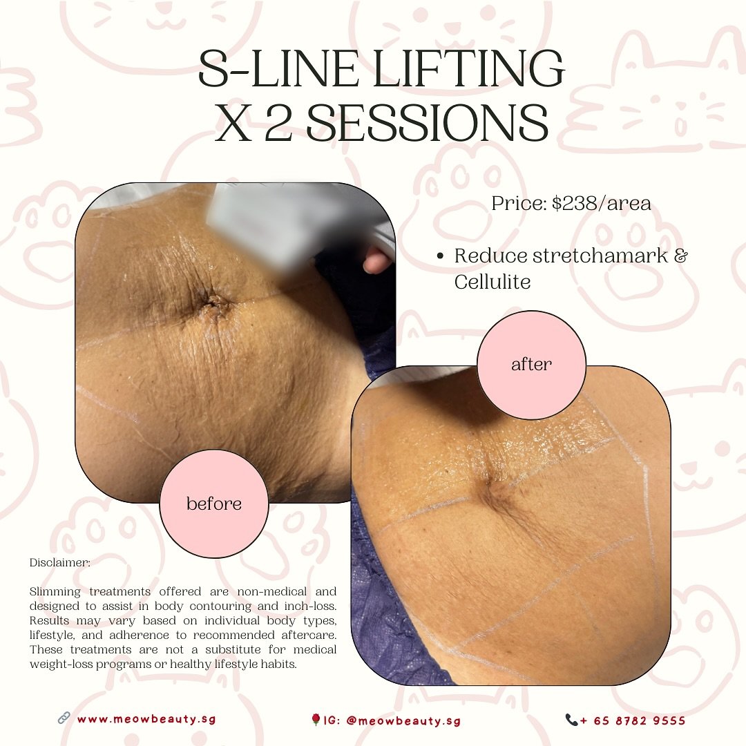 S-Line Lifting Treatment &ndash; Smooth, Firm, Refine

Our S-Line Lifting is a targeted body treatment designed to visibly improve the appearance of stretch marks, sagging skin, and cellulite. Using non-invasive lifting technology, this treatment tig