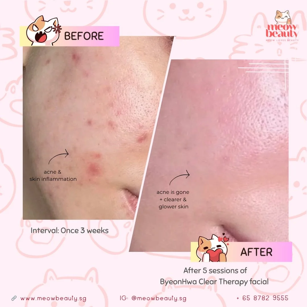 Do yall know&hellip; 💡 

𝘽𝙮𝙚𝙤𝙣𝙝𝙬𝙖 𝘾𝙡𝙚𝙖𝙧 𝙏𝙝𝙚𝙧𝙖𝙥𝙮 𝙞𝙨 𝙖𝙘𝙩𝙪𝙖𝙡𝙡𝙮 𝙤𝙣𝙚 𝙤𝙛 𝙩𝙝𝙚 𝙗𝙚𝙨𝙩 𝙖𝙣𝙩𝙞-𝙖𝙘𝙣𝙚 𝙛𝙖𝙘𝙞𝙖𝙡𝙨 𝙬𝙚 𝙝𝙖𝙫𝙚 𝙖𝙩 𝙈𝙚𝙤𝙬 𝘽𝙚𝙖𝙪𝙩𝙮 💛

It&rsquo;s not just a normal facial: 

we combine Car