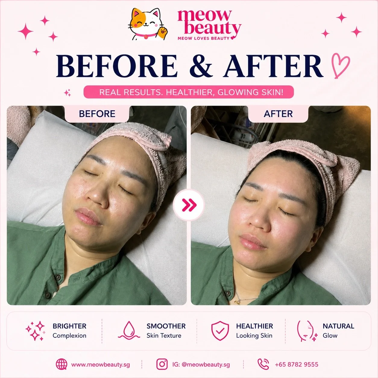 NO FILTER JUST REAL RESULTS! 🩷

#beforeandafter #facial #beauty #beautysalon #glowup