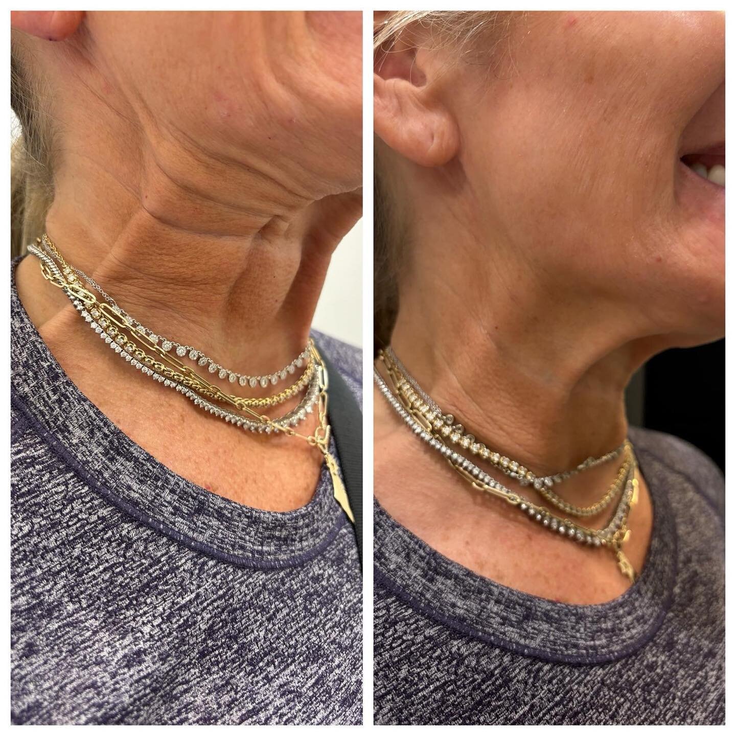Tox treatment on neck bands, also known as &ldquo;platysmal bands&rdquo; involves injecting a small amount of neurotoxins into the muscles that cause the neck lines to form. 
These neck bands are the result of aging 👵🏼, sun damage ☀️, or genetics ?