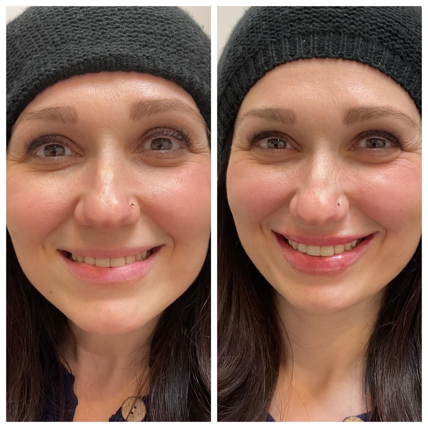 Nothing makes us happier than that smile and excitement ☺️ 
Accentuating her natural shape and beautiful lips, providing more definition, projection and volume in a natural looking way! 😍😍
 #restalynekysse #lipfiller #beauty #facialbalancing