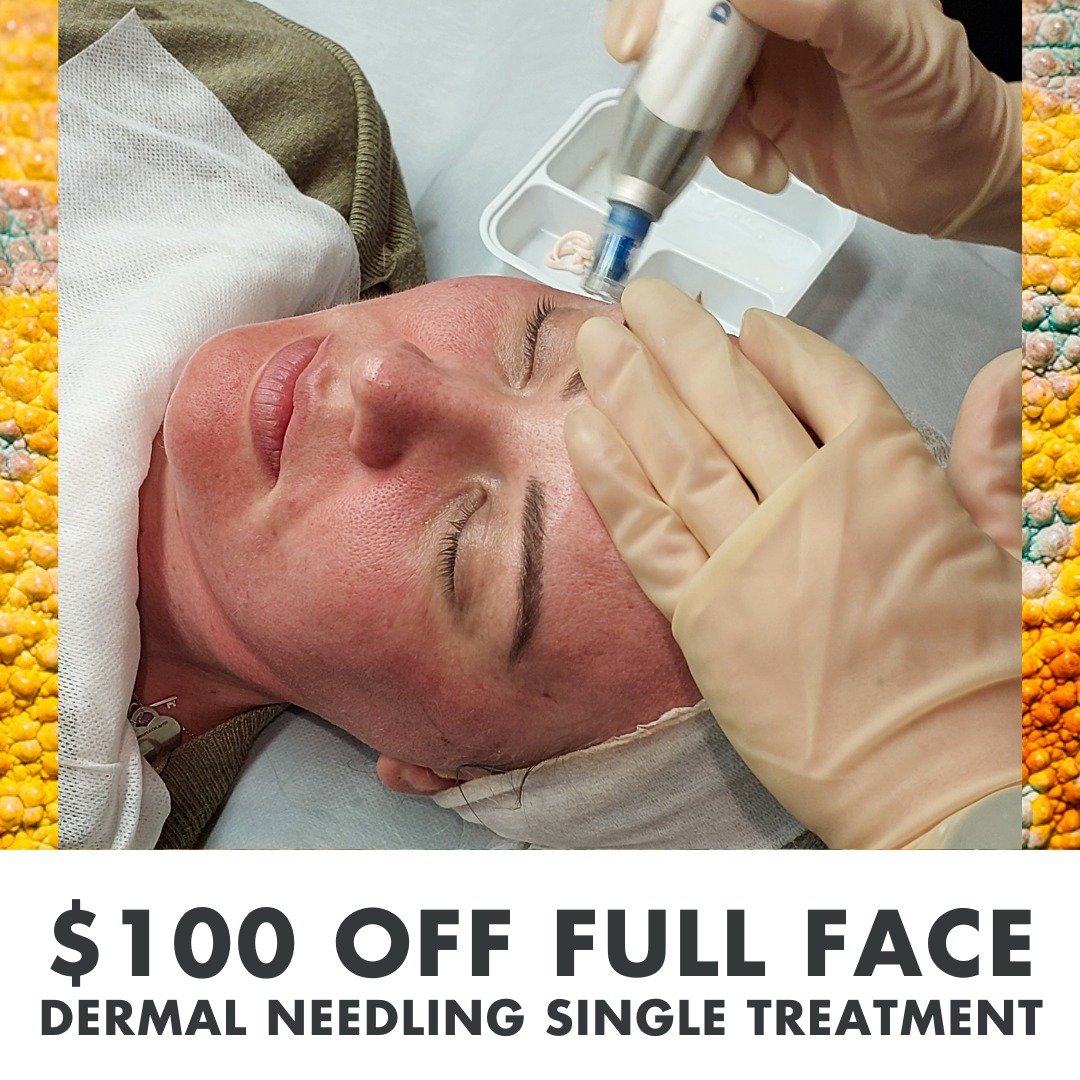 Transform your skin with $100 off single session full face dermal needling! Available this month only!

Our expert team will customise your treatment to address your unique skin concerns. 

Plus, enhance your treatment with Meso-Glide (MG) serum and 