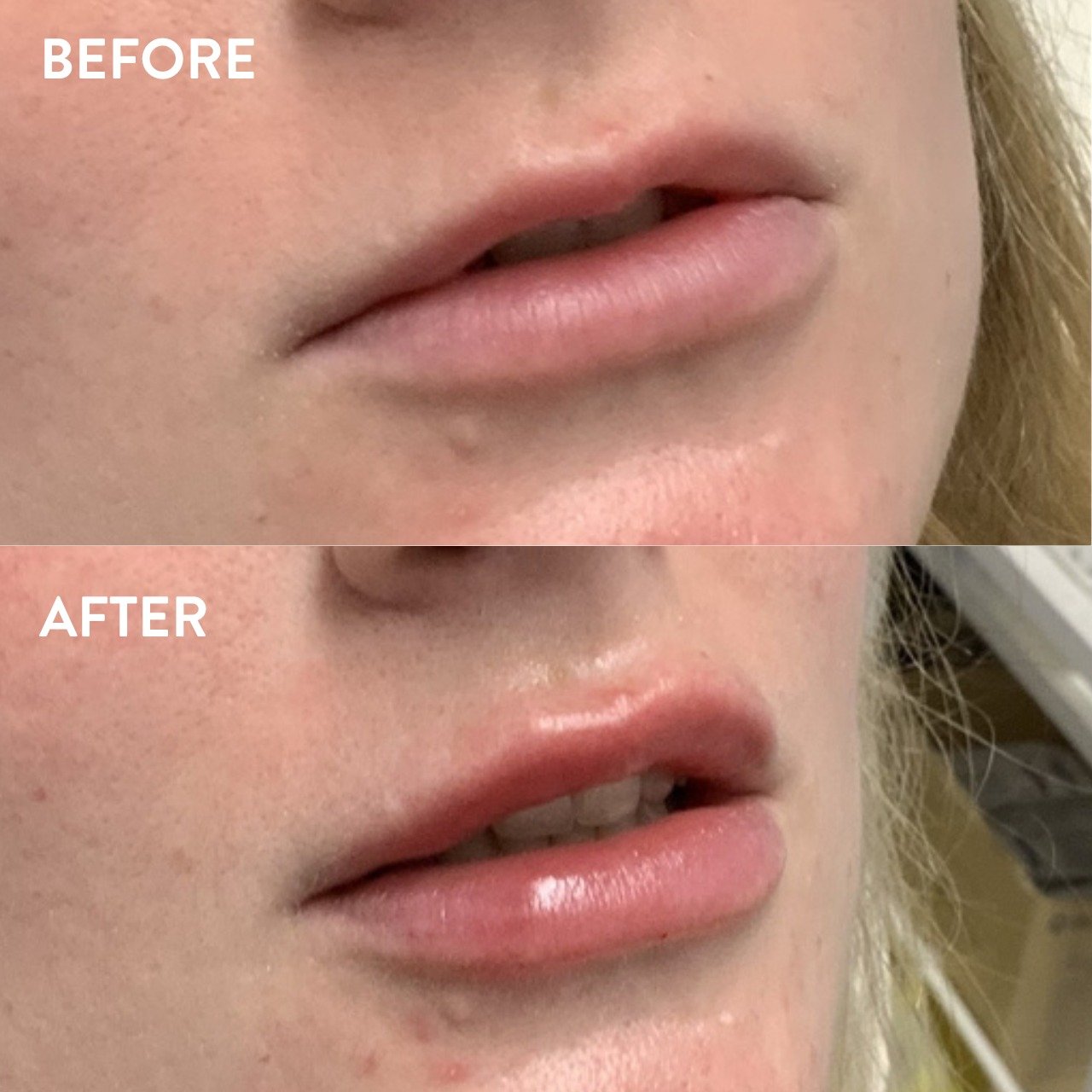 Lip filler is an option for those looking to add balance to their lips or enhance the volume or shape for a fuller or more defined appearance.

If you've been interested in lip filler, book a free consult with our Registered Nurses to find out more.
