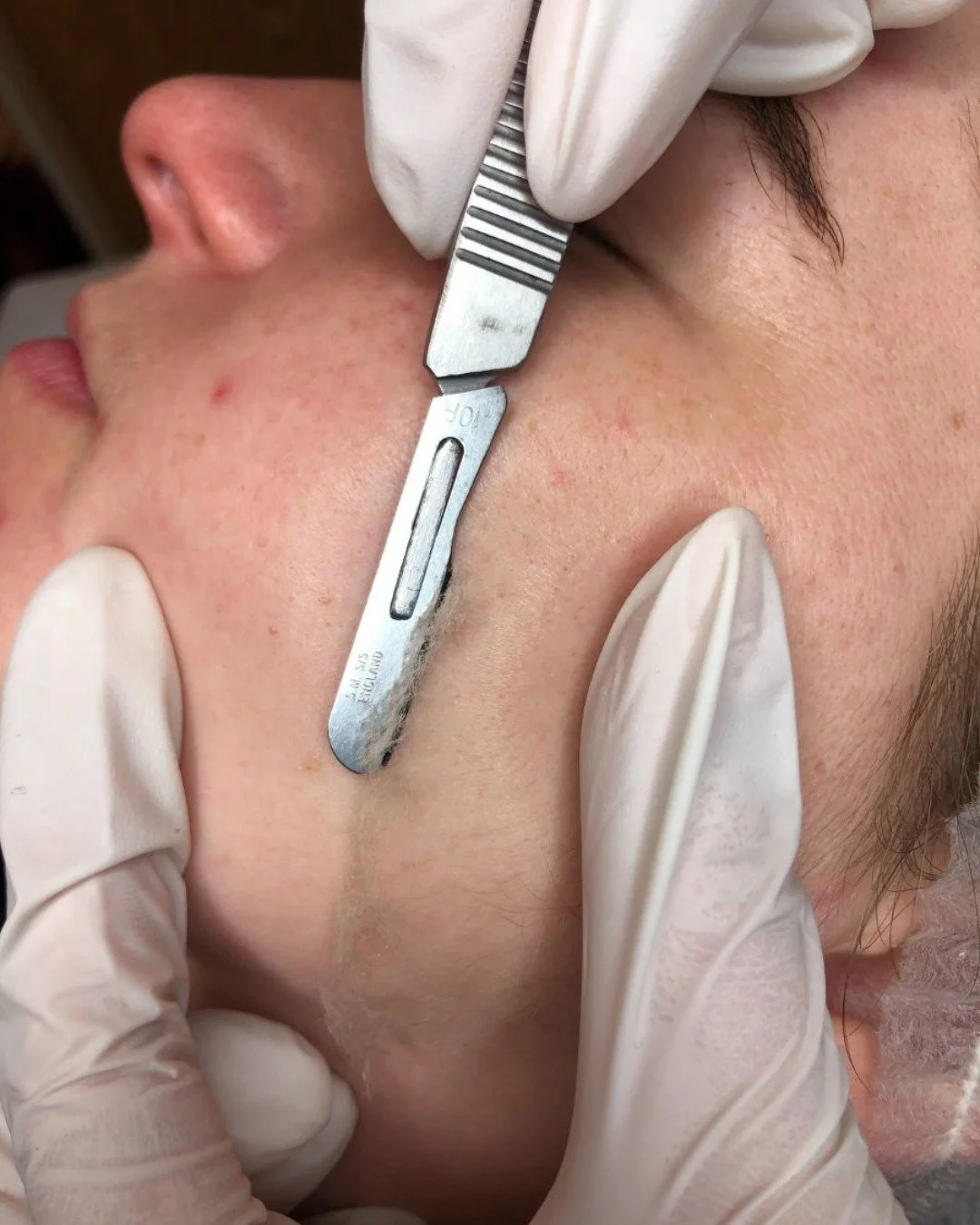 Dermaplaning is your must have treatment this social season. Say goodbye to dull skin and peach fuzz. Hello to smooth, glowing perfection. Book now!