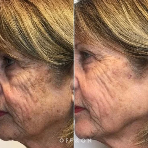 Laser Pigmentation Removal Before After (1).jpg