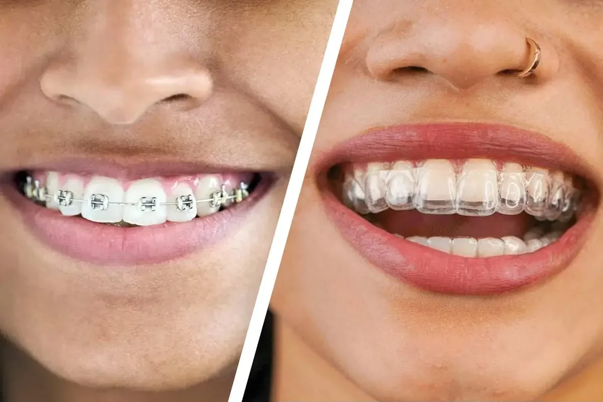 Invisalign vs Traditional Braces: Cost, Comfort, Results &amp; Which is Better