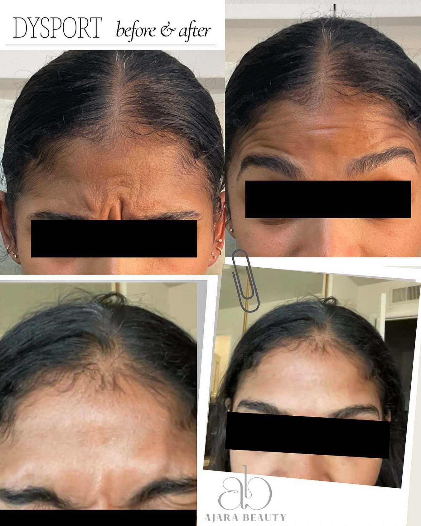 Smooth results, subtle lift ✨
Before & after Dysport 💉
•
📍 643 S Olive St Los Angeles
📧 hello@ajarabeauty.com
📱(323) 205-6315 (text)
🗓️ Book thru Jane App (link in bio)
🍒 Treat now, pay later thru Cherry (link in bio)
•
•
&bu