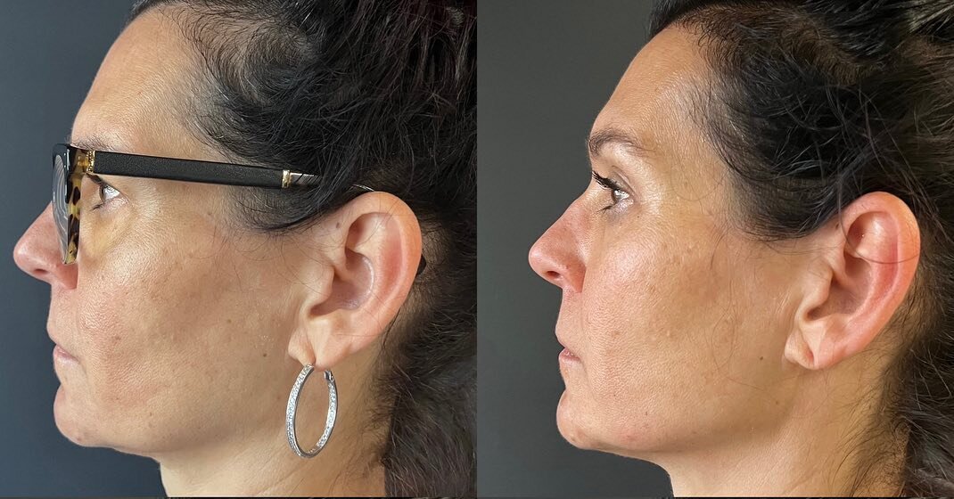 Jawline definition! We were able to sharpen the angle of this beautiful persons jawline, and therefore decrease the appearance of thinning skin.