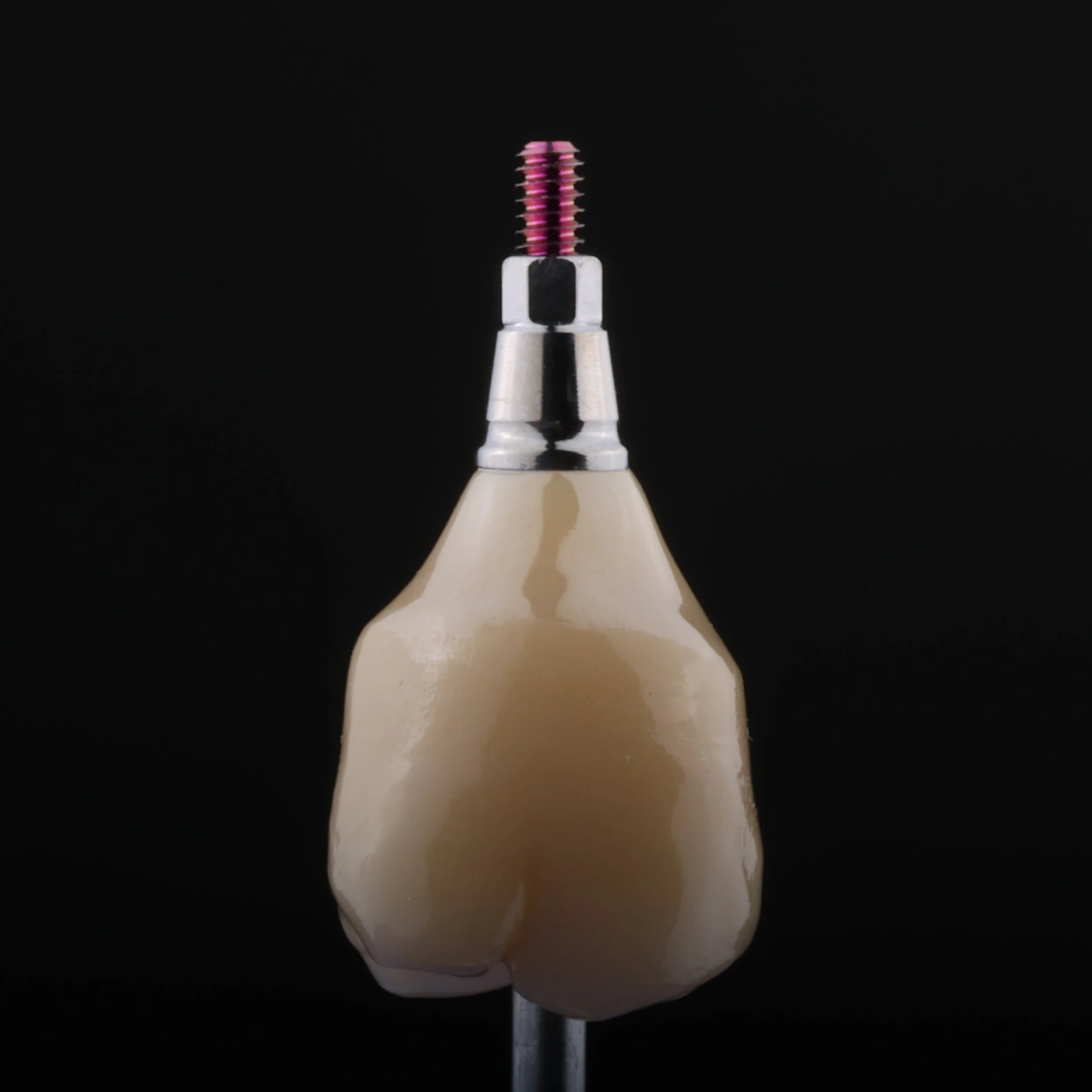 Implantaatkroon met een duidelijk licht concave B-zone en licht convexe E-zone in het emergence profile.