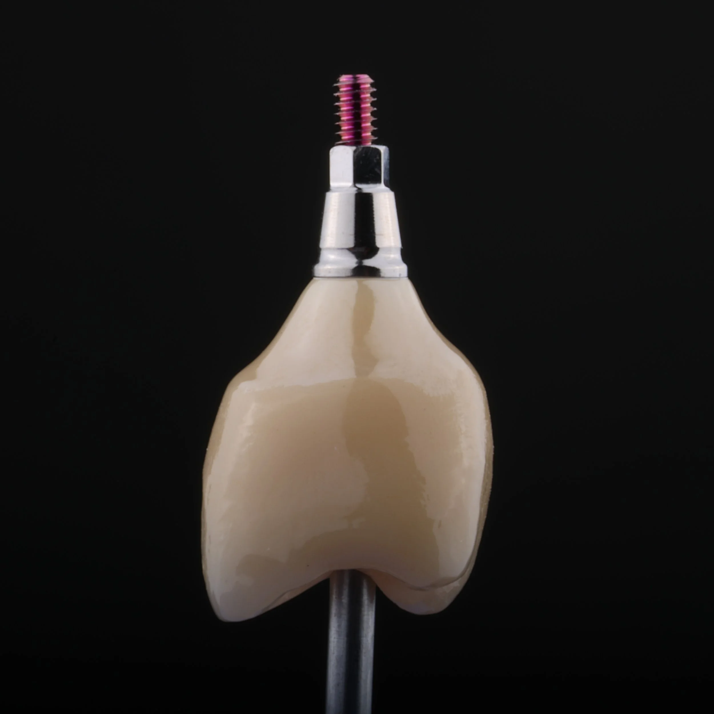 Implantaatkroon met een duidelijk licht concave B-zone en licht convexe E-zone in het emergence profile.