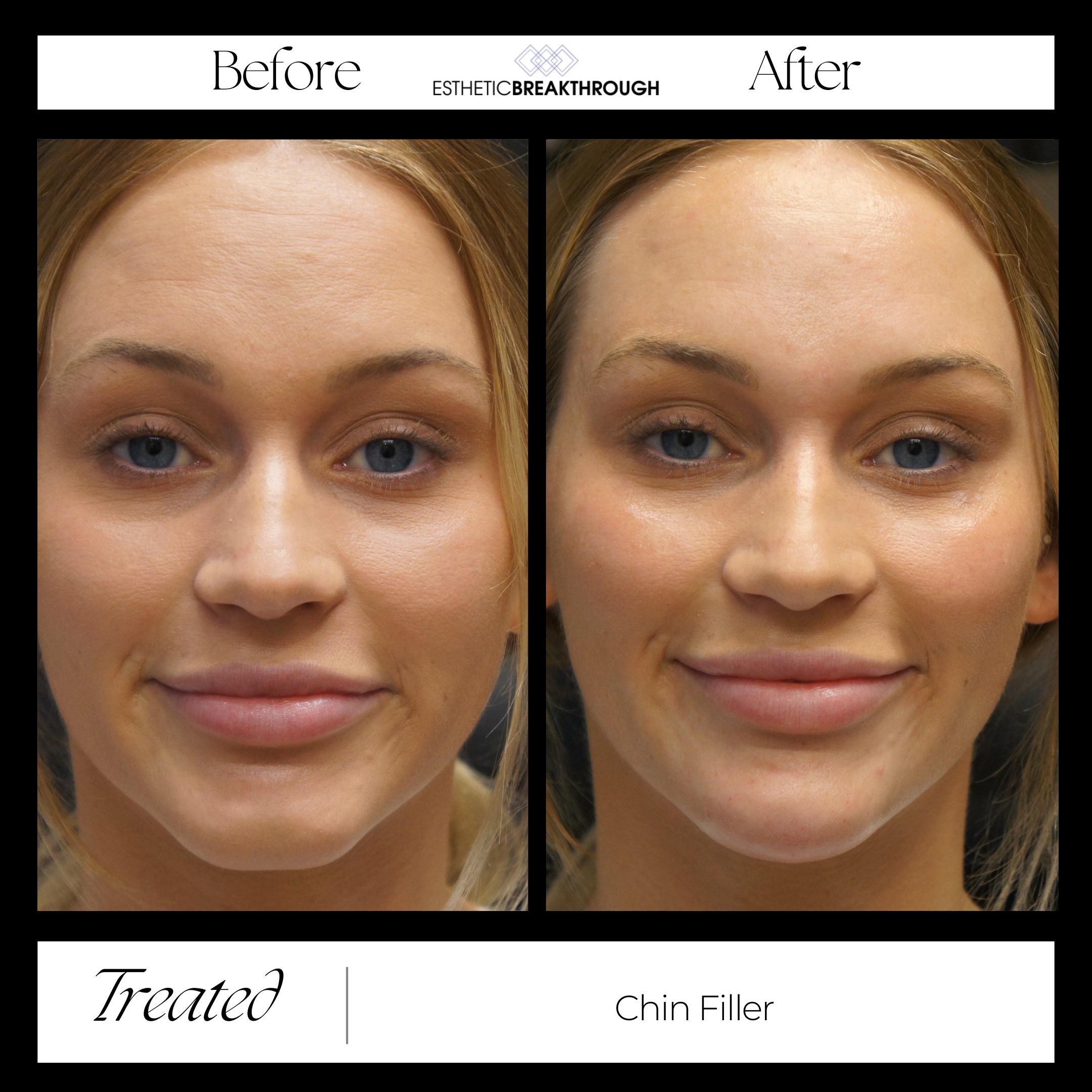 Female Patient Before & After Chin Filler Treatment