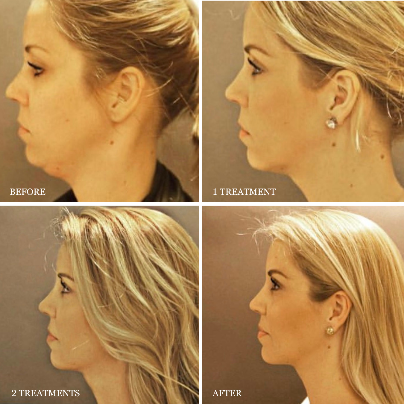 Elevate Your Aesthetic Practice: KYBELLA® Method with Emily Tryon, RN