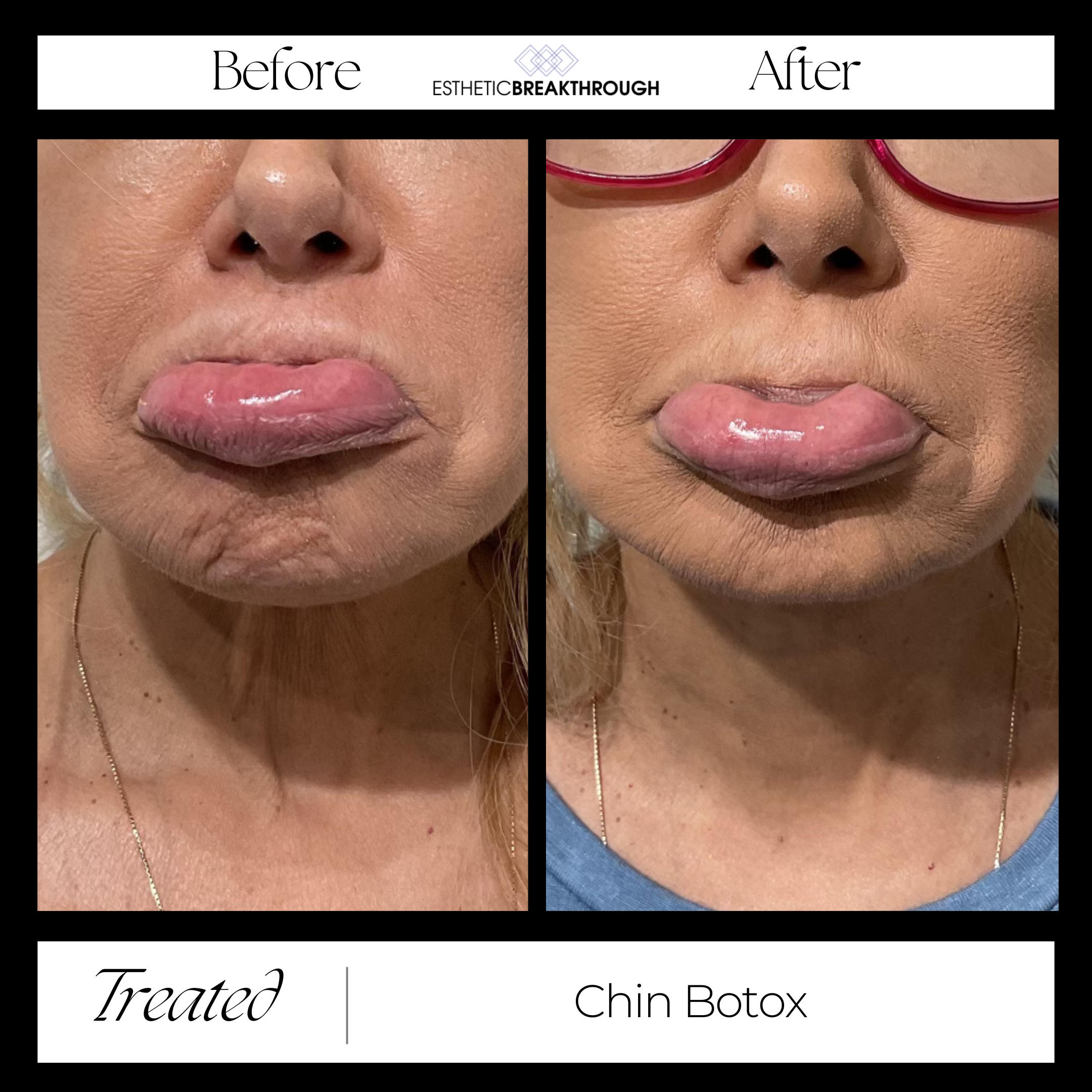 Female Patient Before & After Chin Botox Image