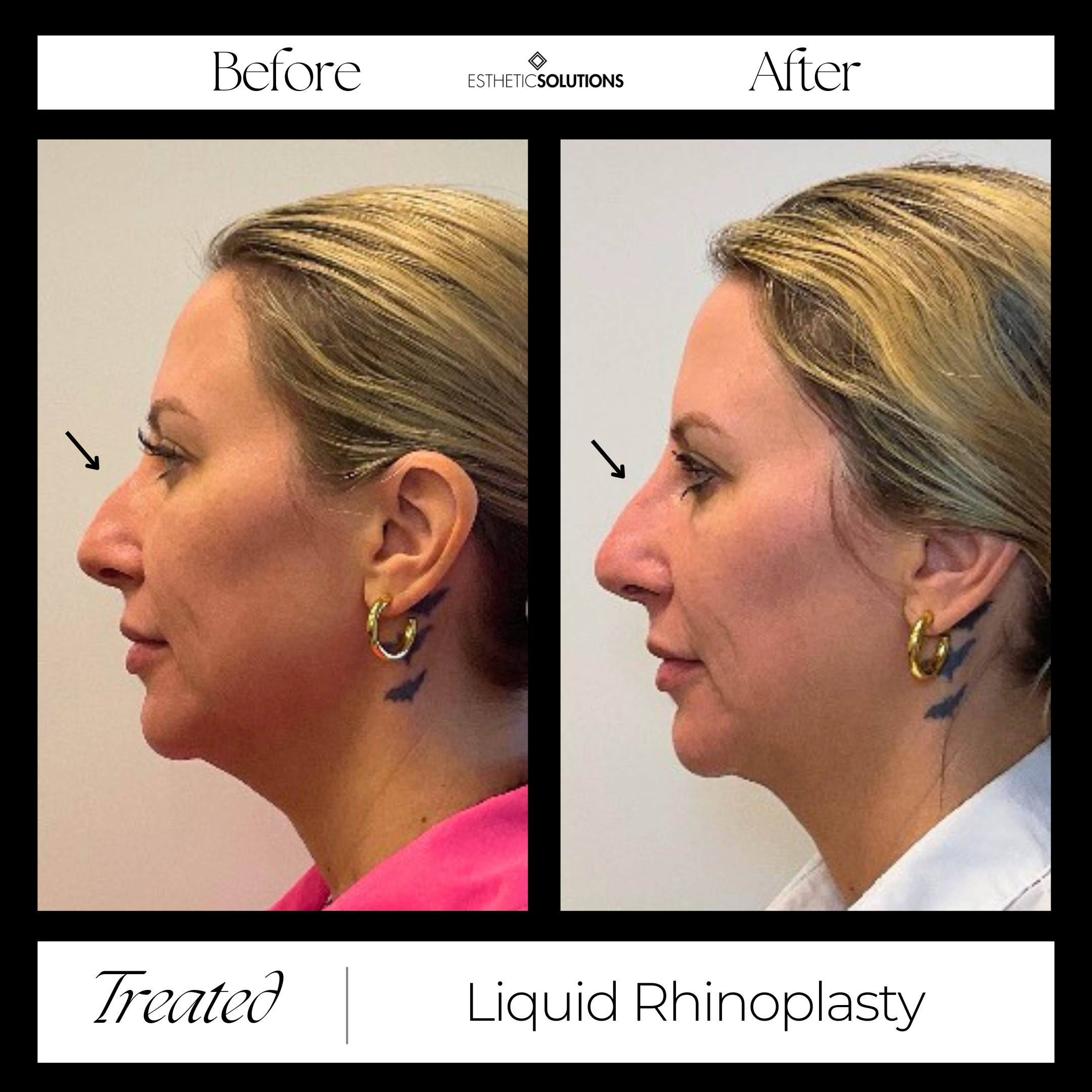 Before & After Image of Liquid Rhinoplasty Patient at Esthetic Solutions