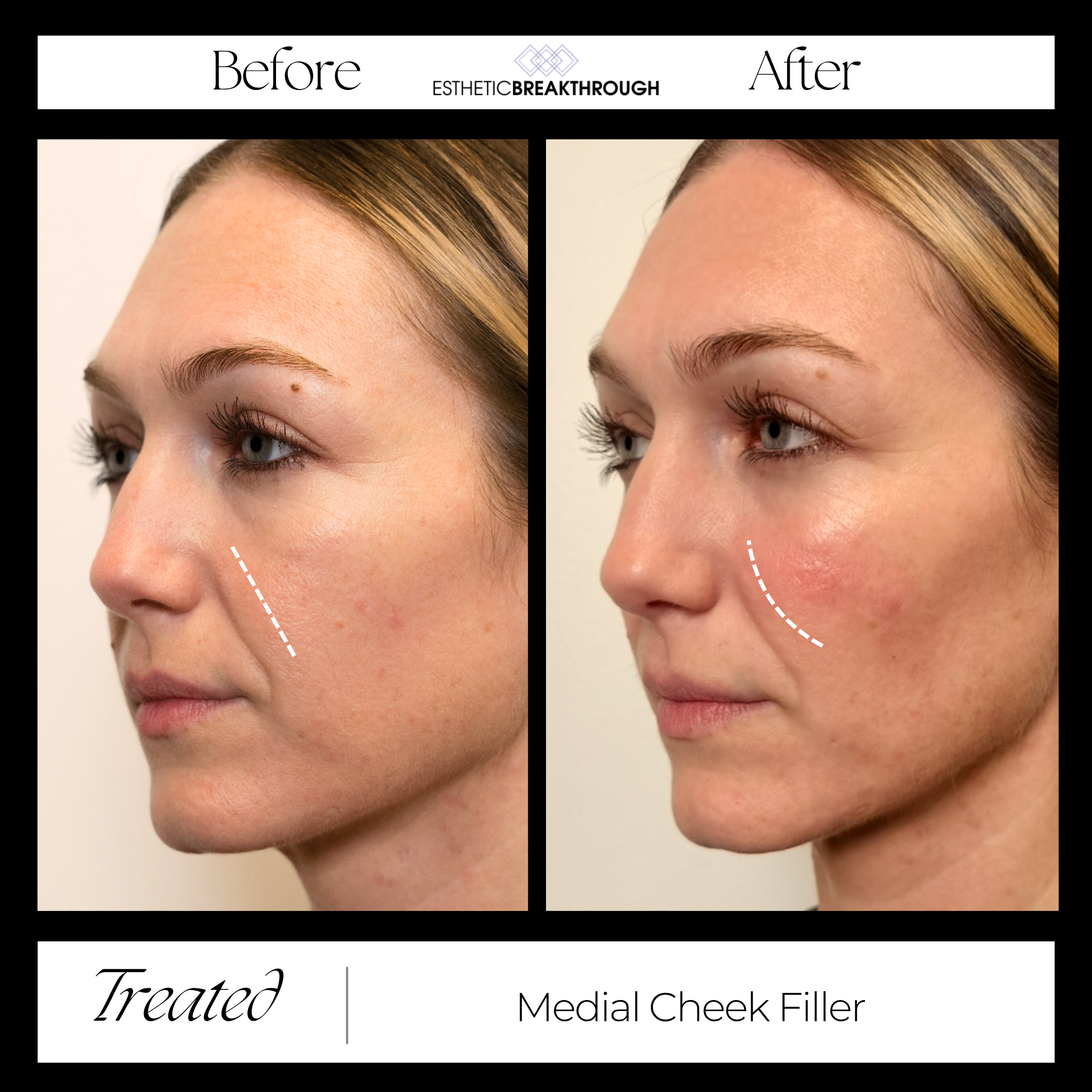 Medial Cheek Filler Patient Before and After