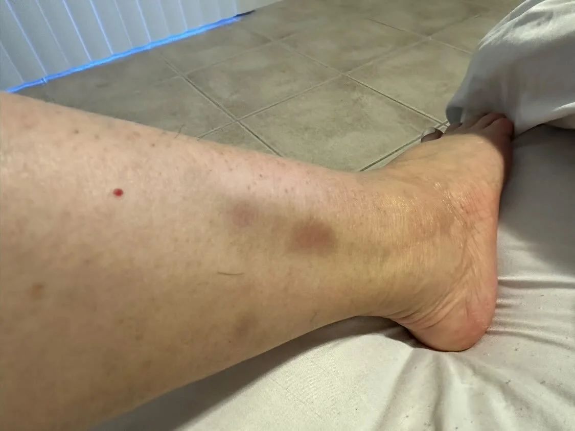 variegate porphyria blisters
