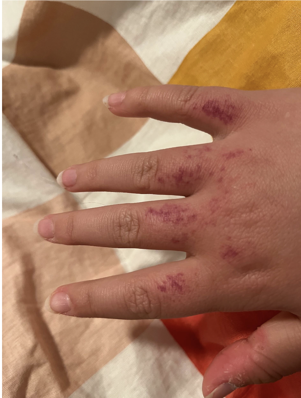 epp reaction sun allergy
