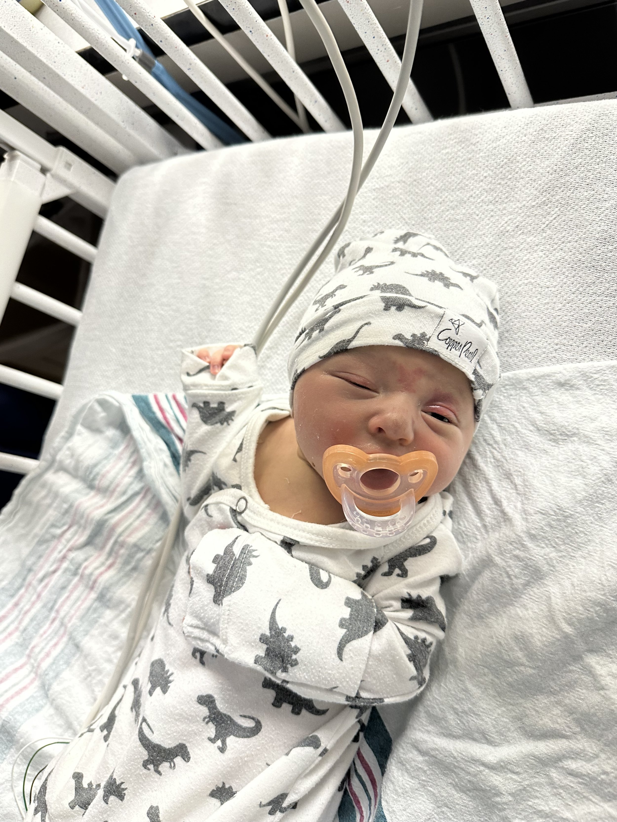 baby with congenital erythropoietic porphyria