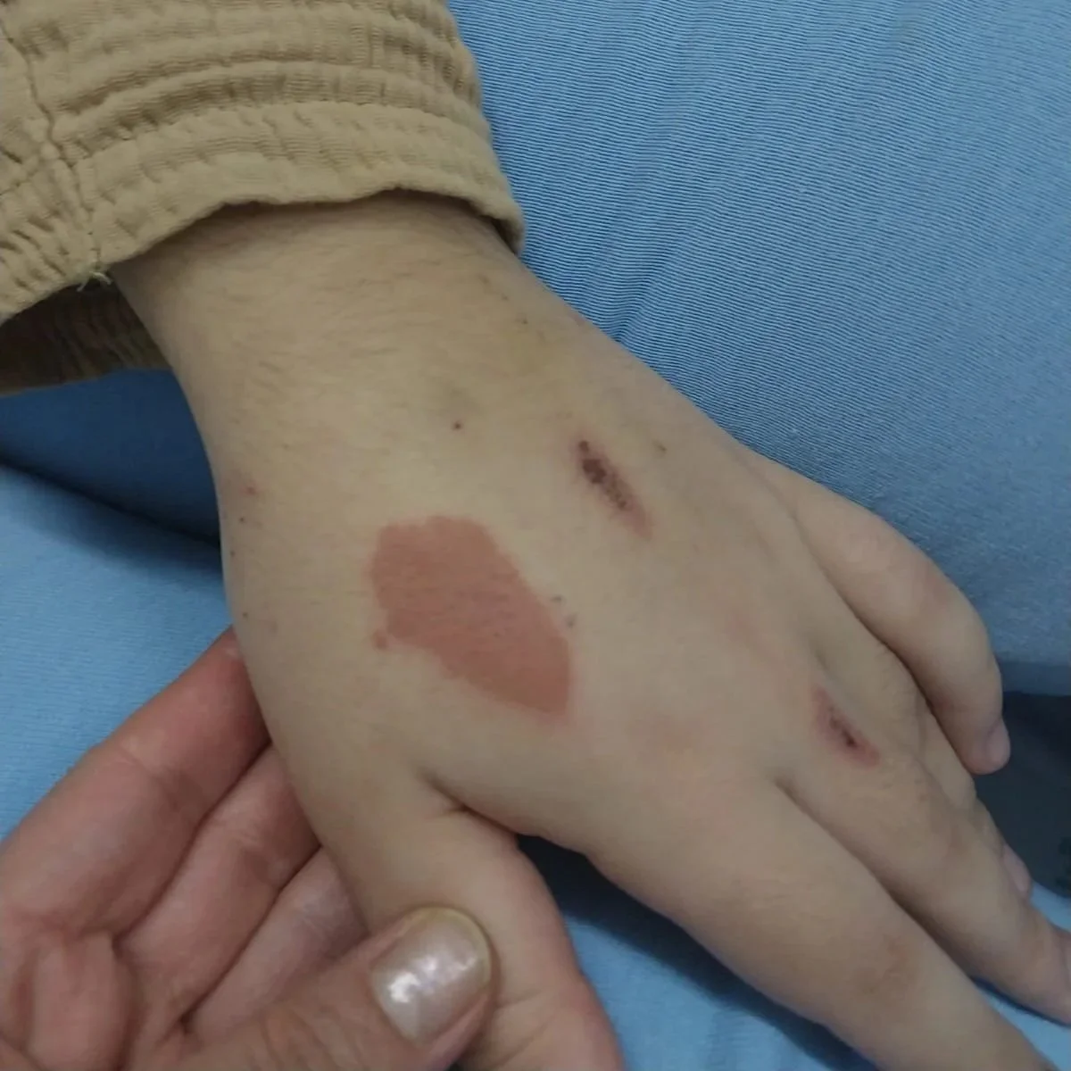 hand of a porphyria patient