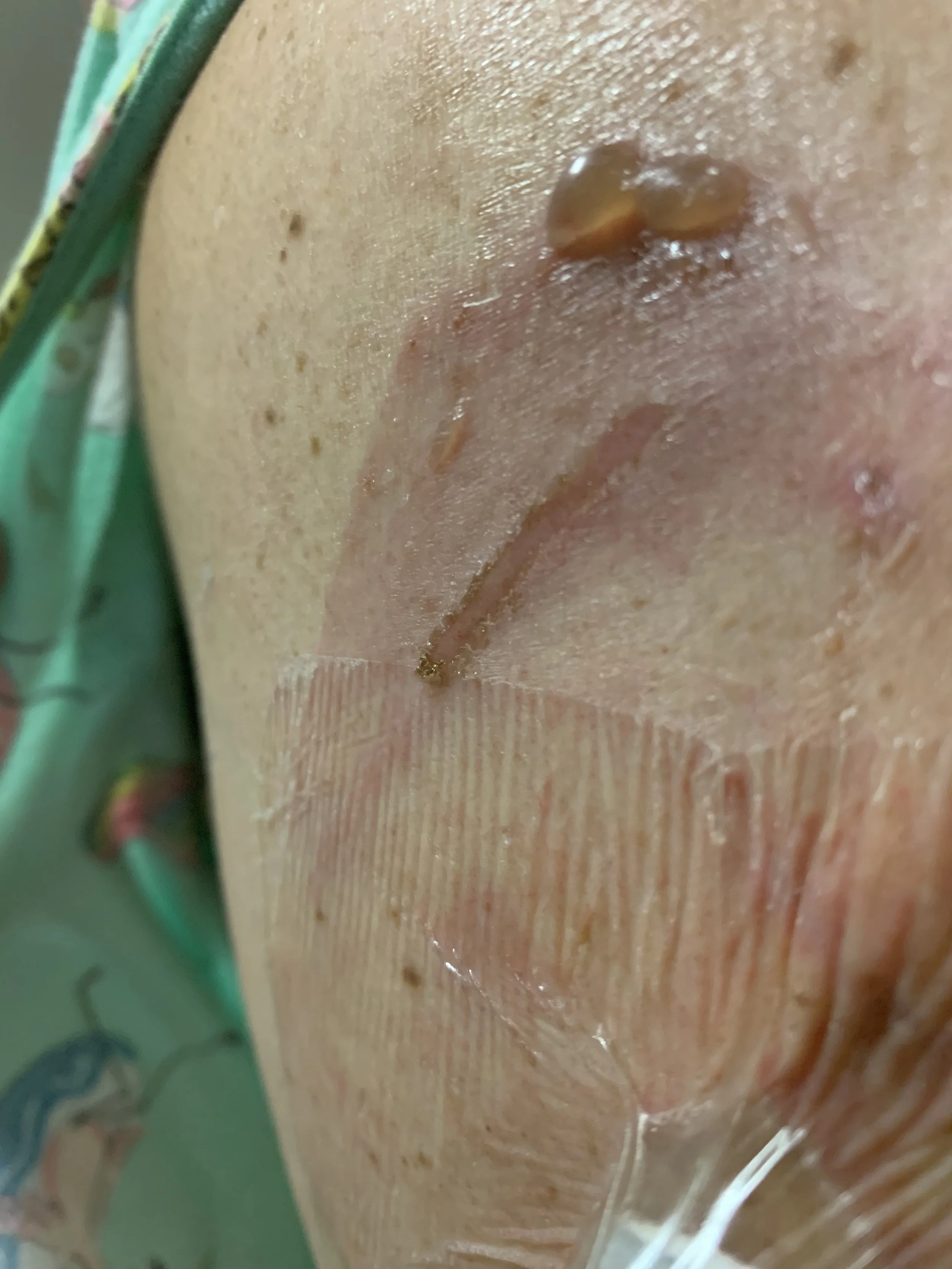 blister variegate porphyria