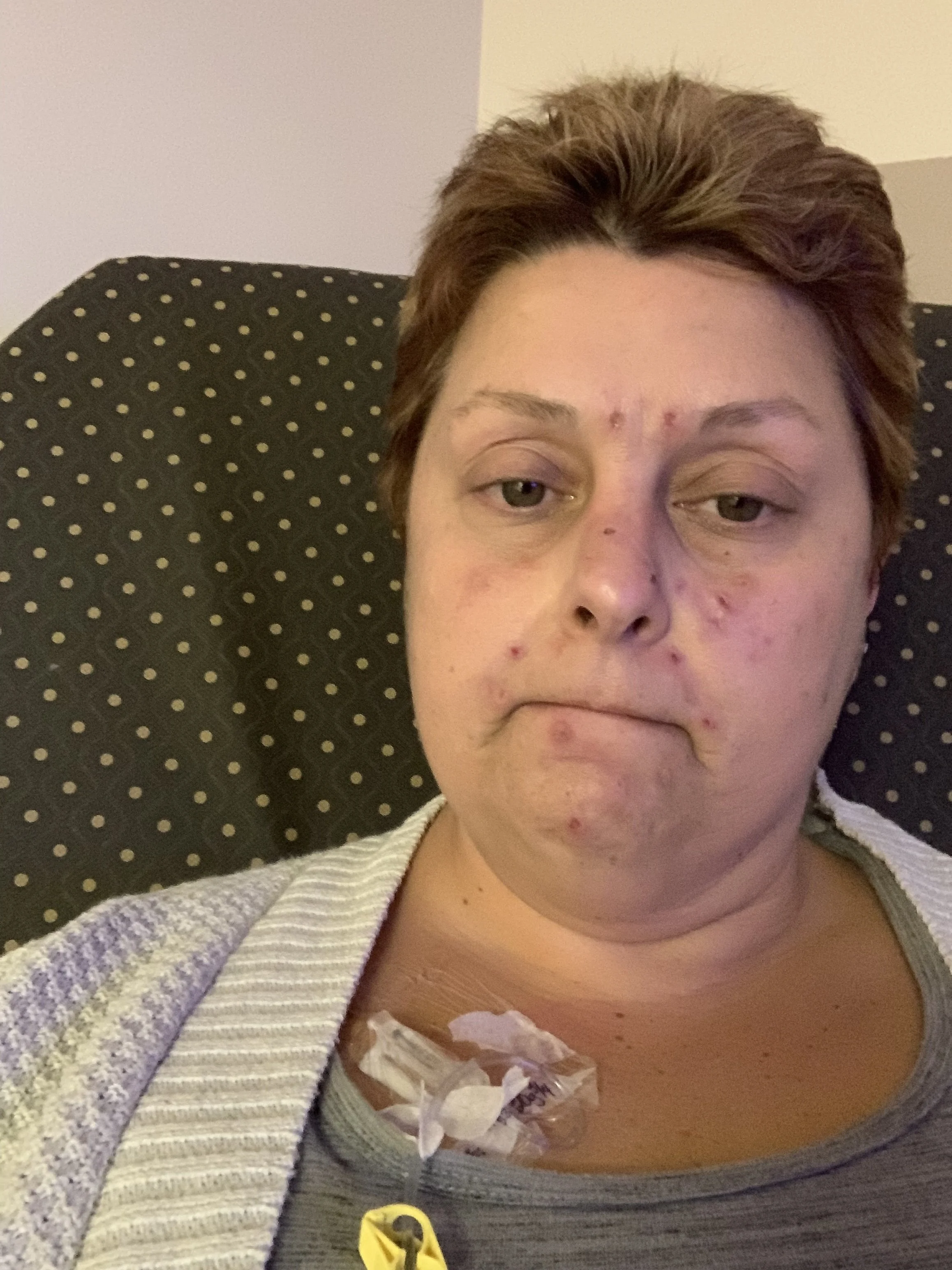 woman in hospital with variegate porphyria