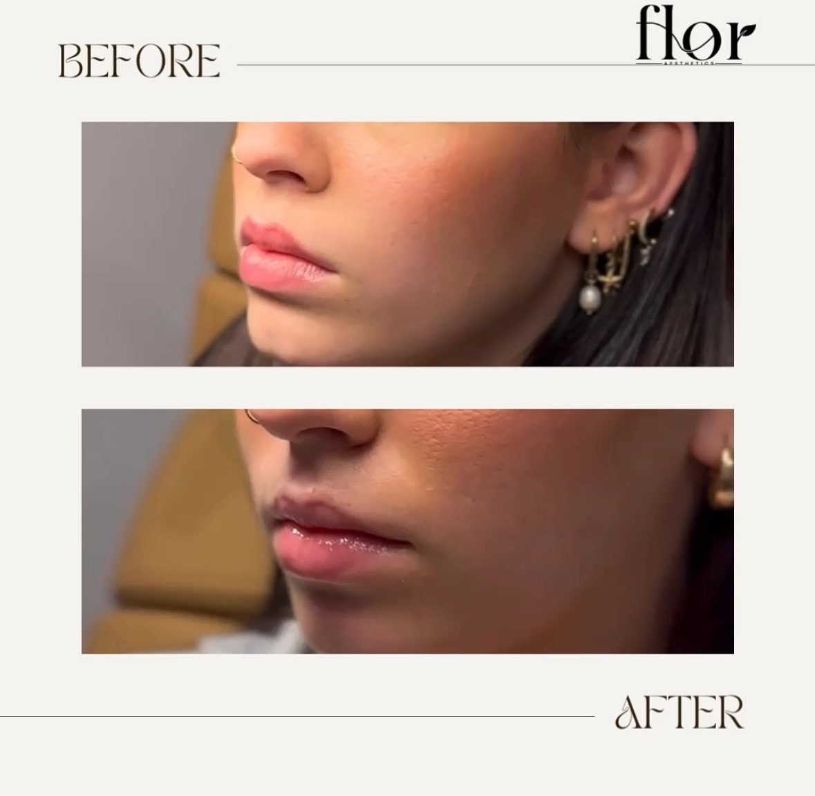 ✨ Before &amp; After Lip Flip ✨

A quick, simple, and effective way to enhance your smile using Botox, Dysport, or Xeomin! This subtle treatment can last anywhere from a few weeks to months, giving you natural-looking, fuller lips with minimal downti