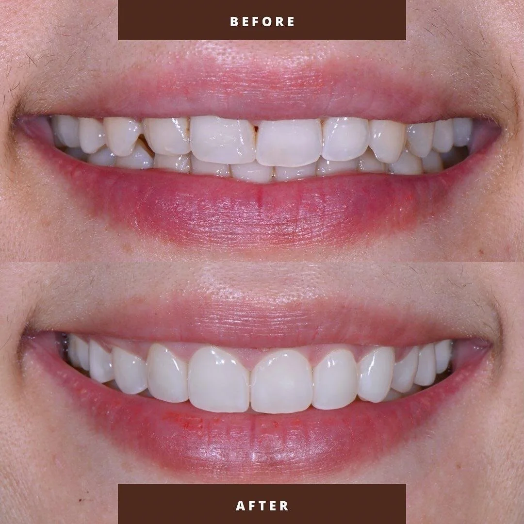 Veneers ohne Schleifen in Frankfurt Westend | Non-Prep-Veneers
