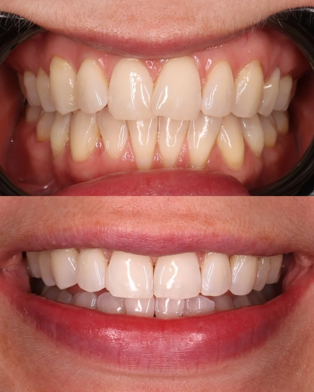 Aligner 1.jpg