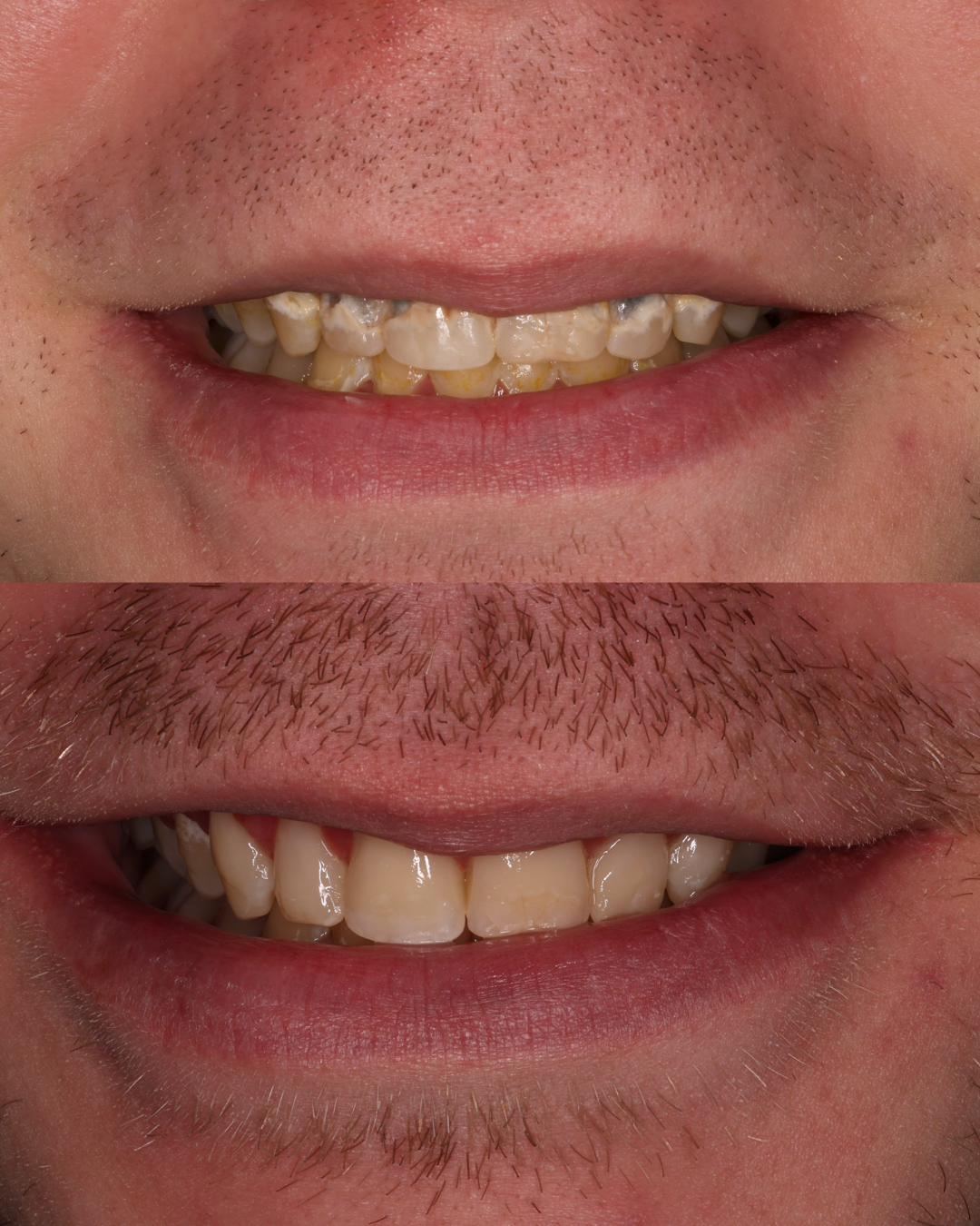 composite bonding  caries removal.png