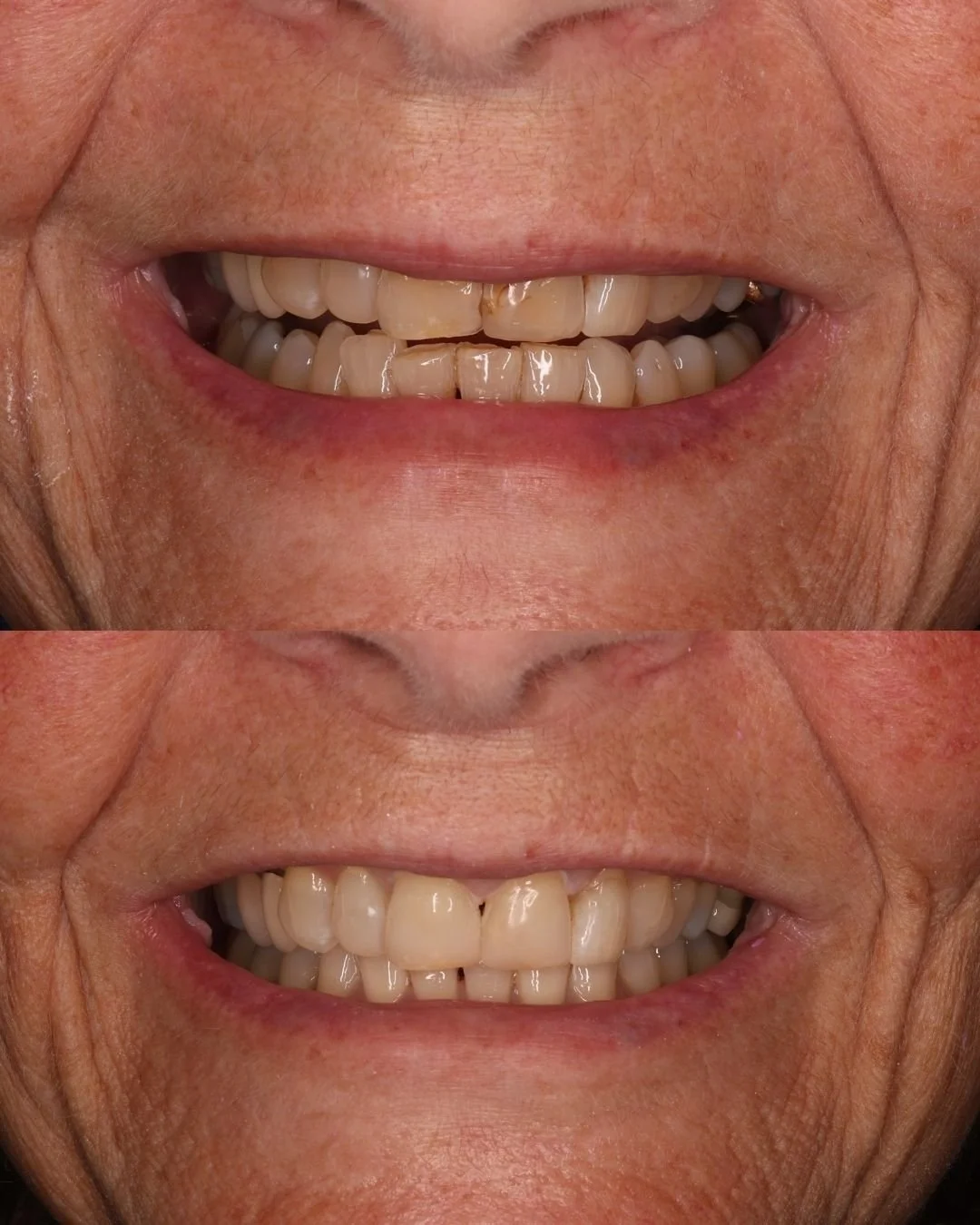 whitening + comp bonding.jpg