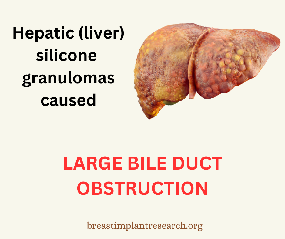 Large bile duct obstruction
