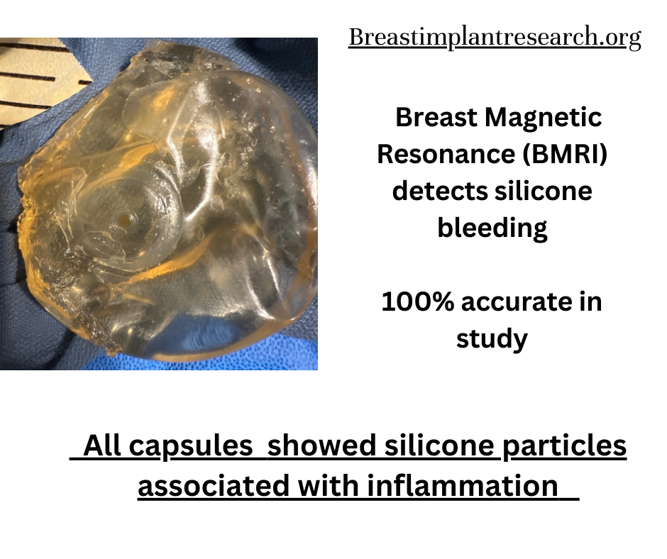 BMRI detects 100% silicone bleed